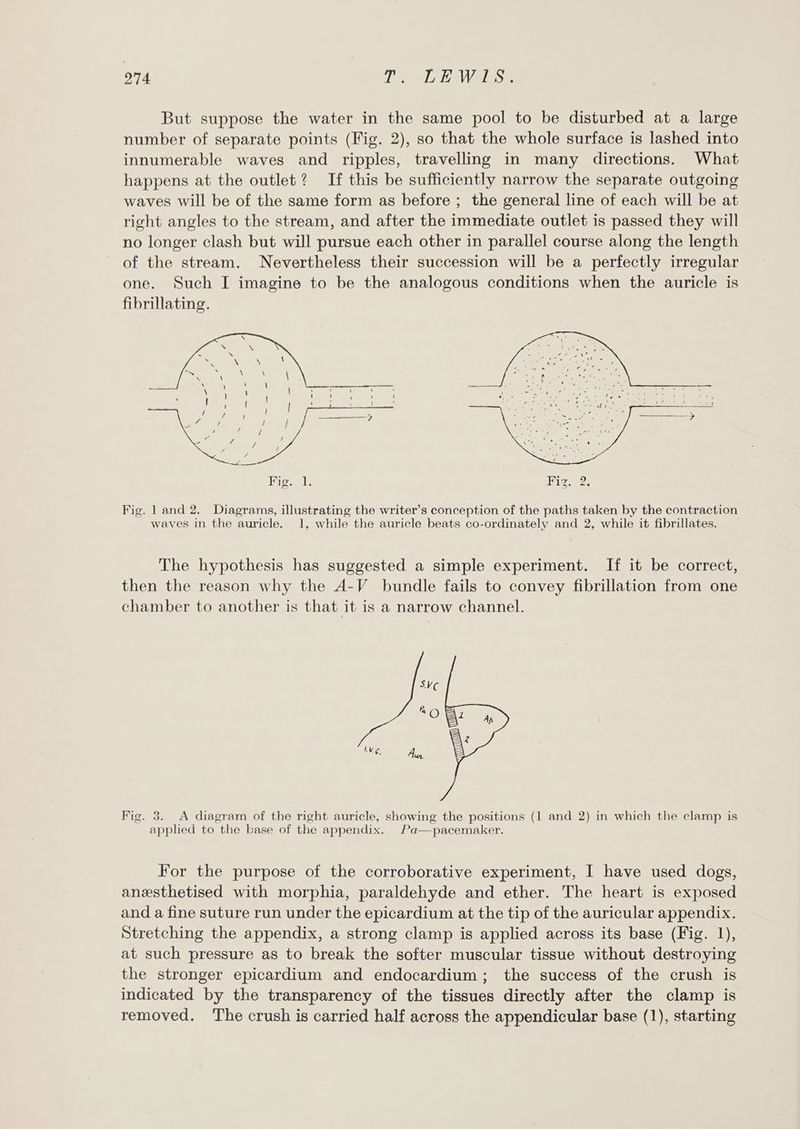 274 Tl. LEWIS. But suppose the water in the same pool to be disturbed at a large number of separate points (Fig. 2), so that the whole surface is lashed into innumerable waves and ripples, travelling in many directions. What happens at the outlet? If this be sufficiently narrow the separate outgoing waves will be of the same form as before ; the general line of each will be at right angles to the stream, and after the immediate outlet is passed they will no longer clash but will pursue each other in parallel course along the length of the stream. Nevertheless their succession will be a perfectly irregular one. Such I imagine to be the analogous conditions when the auricle is fibrillating. Fig. 1 and 2. Diagrams, illustrating the writer’s conception of the paths taken by the contraction waves in the auricle. 1, while the auricle beats co-ordinately and 2, while it fibrillates. The hypothesis has suggested a simple experiment. If it be correct, then the reason why the A-V bundle fails to convey fibrillation from one chamber to another is that it is a narrow channel. Fig. 3. A diagram of the right auricle, showing the positions (1 and 2) in which the clamp is appled to the base of the appendix. Pa—-pacemaker. For the purpose of the corroborative experiment, I have used dogs, anzsthetised with morphia, paraldehyde and ether. The heart is exposed and a fine suture run under the epicardium at the tip of the auricular appendix. Stretching the appendix, a strong clamp is applied across its base (Fig. 1), at such pressure as to break the softer muscular tissue without destroying the stronger epicardium and endocardium; the success of the crush is indicated by the transparency of the tissues directly after the clamp is