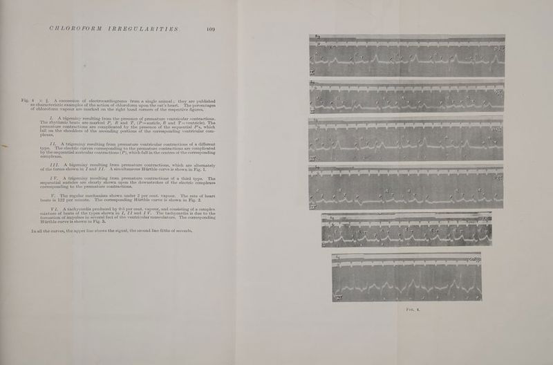 Big t 3 &amp;: A succession of electrocardiograms from a single animal; they are published as characteristic examples of the action of chloroform upon the cat’s heart. The percentages of chloroform vapour are marked on the right hand corners of the respective figures. Z. A bigeminy resulting from the presence of premature ventricular contractions. The rhythmic beats are marked P, R and J, (P=auricle, R and 7’=ventricle). The premature contractions are complicated by the presence of the sequential P’s, which a on the shoulders of the ascending portions of the corresponding ventricular com- plexes. II, A trigeminy resulting from premature ventricular contractions of a different type. The electric curves corresponding to the premature contractions are complicated by the sequential auricular contractions (P), which fall in the centres of the corresponding complexes. III. A bigeminy resulting from premature contractions, which are alternately of the forms shown in Jand JZ. A simultaneous Hiirthle curve is shown in Fig. 1. IV. A trigeminy resulting from premature contractions of a third type. The sequential auricles are clearly shown upon the downstrokes of the electric complexes corresponding to the premature contractions, V. The regular mechanism shown under 2 per cent. vapour. The rate of heart beats is 122 per minute. The corresponding Hiirthle curve is shown in Fig. 2. VI. A tachycardia produced by 0-5 per cent. vapour, and consisting of a complex mixture of beats of the types shown in J, JJ and IV. The tachycardia is due to the formation of impulses in several foci of the ventricular musculature. The corresponding Hiirthle curve is shown in Fig. 3. In all the curves, the upper line shows the signal, the second line fitths of seconds.