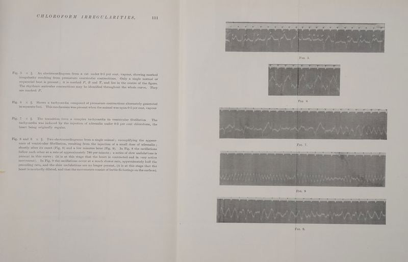 Fig. eS Fig. Fig. Fig. CHLOROFORM IRREGULARITIES. 111 5 x % An electrocardiogram from a cat under 0-5 per cent. vapour, showing marked irregularity resulting from premature ventricular contractions. Only a single normal or sequential beat is present; it is marked P, R and T, and lies in the centre of the figure. The rhythmic auricular contractions may be identified throughout the whole curve. They are marked P. 6 x 3. Shows a tachycaridia composed of premature contractions alternately generated in separate foci. This mechanism was present when the animal was upon 0-5 per cent. vapour 7 x 3 The transition from a complex tachycardia to ventricular fibrillation The tachycardia was induced by the injection of adrenalin under 0-5 per cent chloroform, the heart being originally regular. Sand 9 x 3. Two electrocardiograms from a single animal ; exemplifying the appear- ance of ventricular fibrillation, resulting from the injection of a small dose of adrenalin ; shortly after its onset (Fig. 8) and a few minutes later (Fig. 9). In Fig. 8 the oscillations follow each other at a rate of approximately 780 per minute; a series of slow undulations is present in this curve; (it is at this stage that the heart is contracted and in very active movement). In Fig. 9 the oscillations occur at a much slower rate, approximately half the preceding rate, and the slow undulations are no longer present, (it is at this stage that the heart is markedly dilated, and that the movements consist of feeble flickerings on the surface).