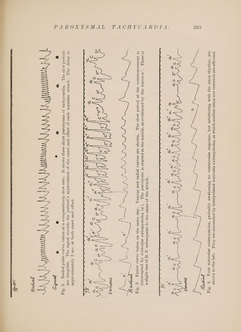 26 TACHYCARD I A. PAROXYSMAL ‘poqooYe O1B O[OIIJUGA TOU SNUIS JOY4IOU YOIYM Ut ‘SeTO4SASBIZXO IBTNOIINV pozepodsojur Aq popeooons oie AY, “AJOT Oy} 07 UMOYS oie ‘WUYyJAYI SNUIS 94} YIM SulsJeyIezUI 4ynq ‘osuodses Ie~NoTIZUeA OU SuUTUCYeMeB ATqeqoid ‘soyo4shEVIYXO IBTNOIMe Mog ‘p ‘ST 98448 OYZ JO yOSUO OY 07 UONbesqns ‘g “g jo OSTI 4YSIS B SIo10y], *,,D SeABM eY4y Aq POoUEPIAS 8B ‘o[IIINB OY} UI pojIe4s BI wIskxored oY, ‘(,M) sopoj3sAseajyxXe Ie~NoINe Aq poydnas097UT ST JUSUTEDUOUIUIOD oY} 9B pottod MOTs OY], “WMOYS CIB SOAINO [VIPeI puB sNOUGA ‘ABP CUBS OY} UO USyRy BAINO JO\Se “Ee “BLT ww a Ps) @ 9 goubs TRACT ROAD aT ATA AS AMAA RecA TD Ra 2