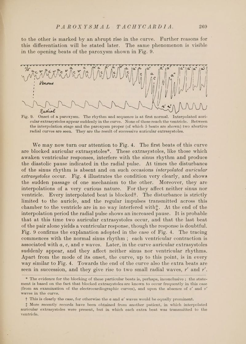 to the other is marked by an abrupt rise in the curve. Further reasons for this differentiation will be stated later. The same phenomenon is visible in the opening beats of the paroxysm shown in Fig. 9. AERA Racal Fig. 9. Onset of a paroxysm. The rhythm and sequence is at first normal. Interpolated auri- cular extrasystoles appear suddenly in the curve. None of these reach the ventricle. Between the interpolation stage and the paroxysm proper (of which 5 beats are shown) two abortive radial curves are seen. Thev are the result of successive auricular extrasystoles. We may now turn our attention to Fig. 4. The first beats of this curve are blocked auricular extrasystoles*. These extrasystoles, like those which awaken ventricular responses, interfere with the sinus rhythm and produce the diastolic pause indicated in the radial pulse. At times the disturbance of the sinus rhythm is absent and on such occasions interpolated auricular extrasystoles occur. Tig. 4 illustrates the condition very clearly, and shows the sudden passage of one mechanism to the other. Moreover, they are interpolations of a very curious nature. For they affect neither sinus nor ventricle. Every interpolated beat is blockedt. The disturbance is strictly limited to the auricle, and the regular impulses transmitted across this chamber to the ventricle are in no way interfered witht. At the end of the interpolation period the radial pulse shows an increased pause. It is probable that at this time two auricular extrasystoles occur, and that the last beat of the pair alone yields a ventricular response, though the response is doubtful. Fig. 9 confirms the explanation adopted in the case of Fig. 4. The tracing commences with the normal sinus rhythm ; each ventricular contraction is associated with a,c, and v waves. Later, in the curve auricular extrasystoles suddenly appear, and they affect neither sinus nor ventricular rhythms. Apart from the mode of its onset, the curve, up to this point, is in every way similar to Fig. 4. Towards the end of the curve also the extra beats are seen in succession, and they give rise to two small radial waves, r’ and 7’. * The evidence for the blocking of these particular beats is, perhaps, inconclusive: the state- ment is based on the fact that blocked extrasystoles are known to occur frequently in this case (from an examination of the electrocardiographic curves), and upon the absence of c’ and v’ waves in the curve. t This is clearly the case, for otherwise the a and a’ waves would be equally prominent. t More recently records have been obtained from another patient, in which interpolated auricular extrasystoles were present, but in which each extra beat was transmitted to the ventricle.