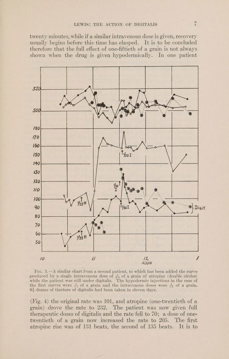 twenty minutes, while if a similar intravenous dose is given, recovery usually begins before this time has elasped. It is to be concluded therefore that the full effect of one-fiftieth of a grain is not always shown when the drug is given hypodermically. In one patient SSO, 500 180 170 160 150 140 k30 120 0 100 90 80 70 60 50 /0 // I: / NOON Fig. 3.—A similar chart from a second patient, to which has been added the curve produced by a single intravenous dose of 5/5 of a grain of atropine (double circles) while the patient was still under digitalis. The hypodermic injections in the case of the first curves were 3'; of a grain and the intravenous doses were =45 of a grain. 94 drams of tincture of digitalis had been taken in eleven days. (Fig. 4) the original rate was 101, and atropine (one-twentieth of a grain) drove the rate to 232. The patient was now given full therapeutic doses of digitalis and the rate fell to 70; a dose of one- twentieth of a grain now increased the rate to 205. ‘The first atropine rise was of 131 beats, the second of 135 beats. It is to
