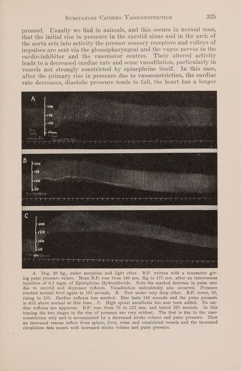 pressed. Usually we find in animals, and this occurs in normal man, that the initial rise in pressure in the carotid sinus and in the arch of the aorta sets into activity the pressor sensory receptors and volleys of impulses are sent via the glossopharyngeal and the vagus nerves to the cardio-inhibitor and the vasomotor centres. Their altered activity leads to a decreased cardiac rate and some vasodilation, particularly in vessels not strongly constricted by epinephrine itself. In this case, after the primary rise in pressure due to vasoconstriction, the cardiac rate decreases, diastolic pressure tends to fall, the heart has a longer 2 wa ho S12 te Ss WL es PD De Oa pee Jet EY OE oe aa a ae 7 PG ges Ts ae a ST BT as a geareaet @ 7 Sata Aan ea fat fetes ieee itaee se sae sage cece ear ee a ee eae ae serine me A. Dog, 20 kg., under morphine and light ether. B.P. written with a tonometer giv- ing pulse pressure values. Mean B.P. rose from 140 mm. Hg to 175 mm. after an intravenous injection of 0.1 mgm. of Epinephrine Hydrochloride. Note the marked decrease in pulse rate due to carotid and depressor reflexes. Vaosdilation undoubtedly also occurred. Pressure reached normal level again in 105 seconds. B.. Now under very deep ether. B.P. lower, 85, rising to 155. Cardiac reflexes less marked. Rise lasts 140 seconds and the pulse pressure is still above normal at this time. C. High spinal anesthesia has now been added. No e¢ar- diac reflexes are apparent. B.P. rose from 72 to 215 mm. and lasted 225 seconds. In this tracing the two stages in the rise of pressure are very evident. The first is due to the vaso- constriction only and is accompanied by a decreased stroke volume and pulse pressure. Then an increased venous inflow from spleen, liver, veins and constricted vessels and the increased circulation rate occurs with increased stroke volume and pulse pressure.
