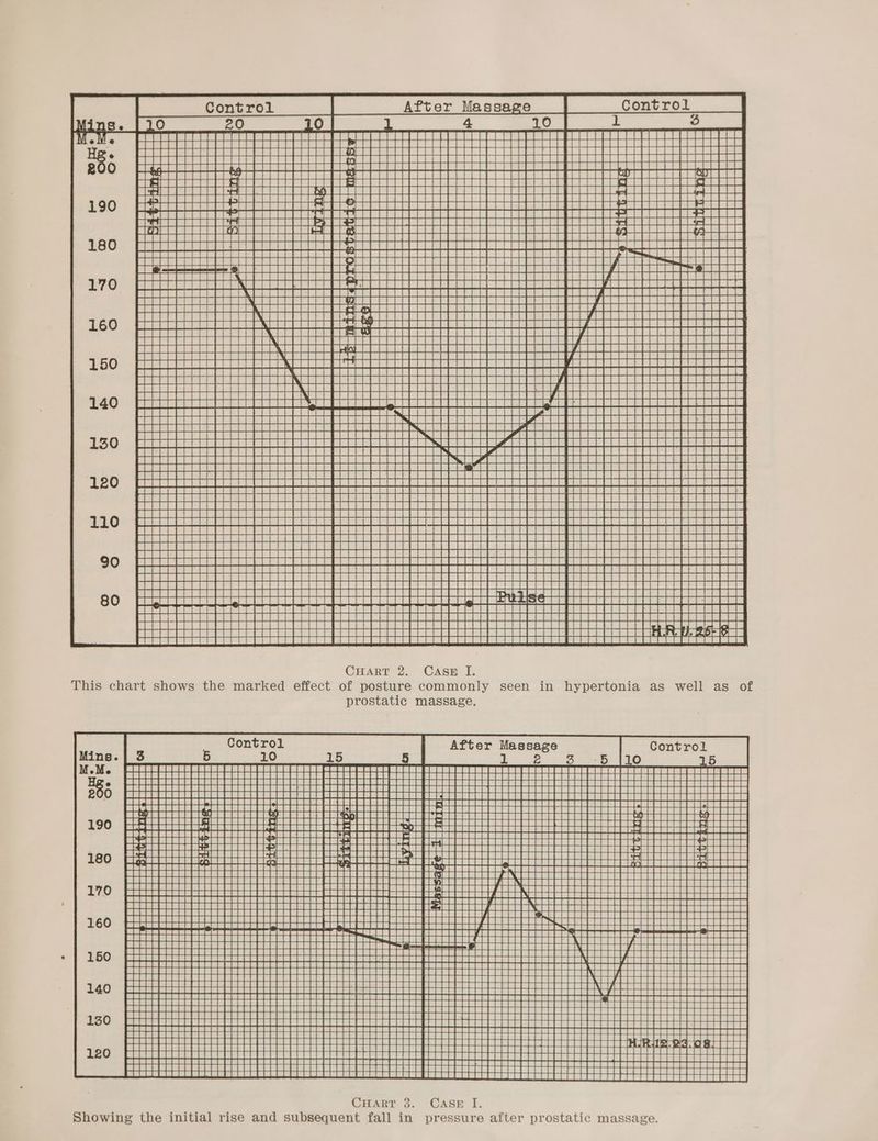 oe Ae a SAA Rates Sees tte tira 8 of: SR Eee TE ORR eth Gai ee bees ia hhh eee CHART 2. Casrm IL = CCAIR 26 ee BE WE CBRE SeSea seu prostatic massage. r Massage Oo CHART 3. CASE I. po ence |} | Pepe ler) Beas BEB SSeS PH A PEEEEEEEEEEEH FEE ECC aS SEES Bia Ri RoR eeEe Giaee ha Sree BERD e ERLE SeES Gara ae | et TI qpek es BEFeESBER RePae Sf Belli BZERBe BEV UERSERS | ee eae one BESae Sb. SG RSE 5-88 aa S=58 EhaEBaS SE? SEEEER Bee Ge ae Bees BEBO a SP SEeaen BORae i | | BaBe EEREOEE a BEREE SEa8 Ska aR sgl | ooce Hg ttt St -88 wel Bip Hebe ee ae ba HH i lode TY HI TT pam SHG ee Ti Tt BEC. BH SSeR tees | an nde a-seee BEES Saf SRaeee Shales ga | ey | oe BMEig Het SRSa8 Bw LAIN TY Rae SESESR = ZeGaR Ena TT NT | EERE Lotti tt tt Tt SeNGE an faeae SaRn PRS RS EaE eSB Haan fe A i ene EASE SSR RSSB Sanaa aaa eit i TTA Lt tty LoS ase Pens PH re FEEENSEE EEE PEE BERG ao ga a REECE ZS e8 as BRAS Ros Fae REP SSES SE Se eRes Saswa aH DEASaBS | I aes ett hale BB PEELE EE NS LA | ao ReesR eee SRSan an BRSES IN ‘A5E8 SE BEER SES Saaen ae see iT TM SERED RUEC PEO Ra eee fee +: suas sussuaaes vauay Ceaseeeedereeaeeee SSEaR | | naan ae . an co co H rH PH FF PEERS os i: STE SEEIzATaAR ER ia neeeataeainteeeeee ete | 4 Poorer tt PREECE SaG Be EMZEeS BEBE COREE CEPR ERR ROAR RP ES Gag aa HRBEREa ROBE CSUSB Dee eRe ee SOeE ese — + SUEIGESETETSAANRRTTEEERETEEELERDERTES pers) aa GEOR sae S0S000G00 06 sr<>SaShenPSeeeee Rae Ee HHH SESS RRSSSe). ie) -A--A A eh: Se aaa ga SER DA SUNT DRSE RGAE ORES REA eRe oa + SUS SEEET STEEL TEETESEEEETEEETEEEEEEEE ae Be aERE EEO ESGE TEESE GPRS ROR EL ee Ee nas aa RGR Sam: DHL GaE RRR RRRE eee Bea