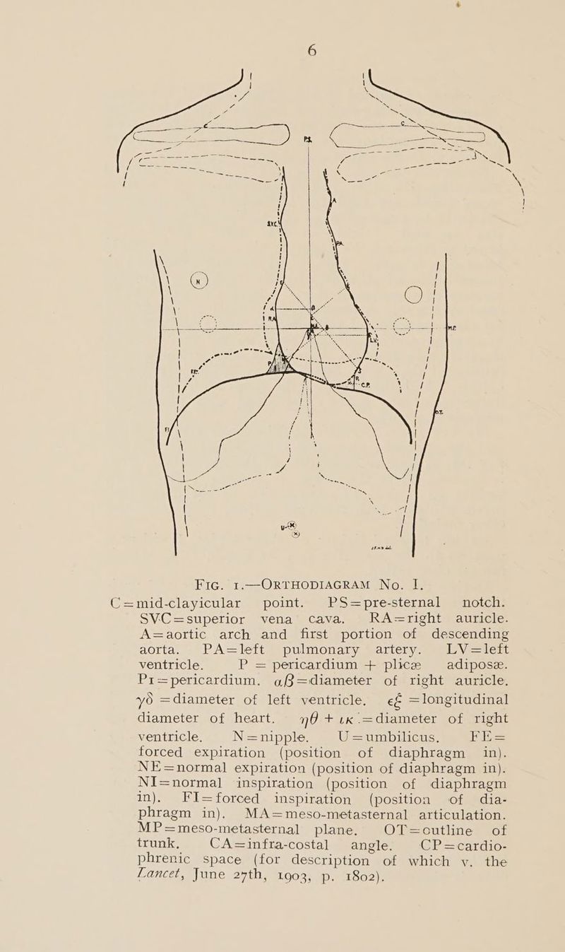 SVC=superior vena cava. RA=right auricle. A=aortic arch and first portion of descending aorta. - PA=lett)) pulmonary Vartery7) 9 Vi—tert ventricle. P = pericardium + plice adipose. Pr=pericardium. g3=diameter of right auricle. yo =diameter of left ventricle. ¢€ =longitudinal diameter of heart. 76+.1x.=diameter of right ventricle. N=nipple. U=umbilicus, FE= forced expiration (position of diaphragm _ in). NE=normal expiration (position of diaphragm in). NI=normal inspiration (position of diaphragm in). FI=forced inspiration (position of dia- phragm in). MA=meso-metasternal articulation. MP=meso-metasternal plane. OT=outline of trunk, CA=infra-costal angle. CP=cardio- phrenic space (for description of which y. the Lancet, June 27th, 1903, p. 1802).