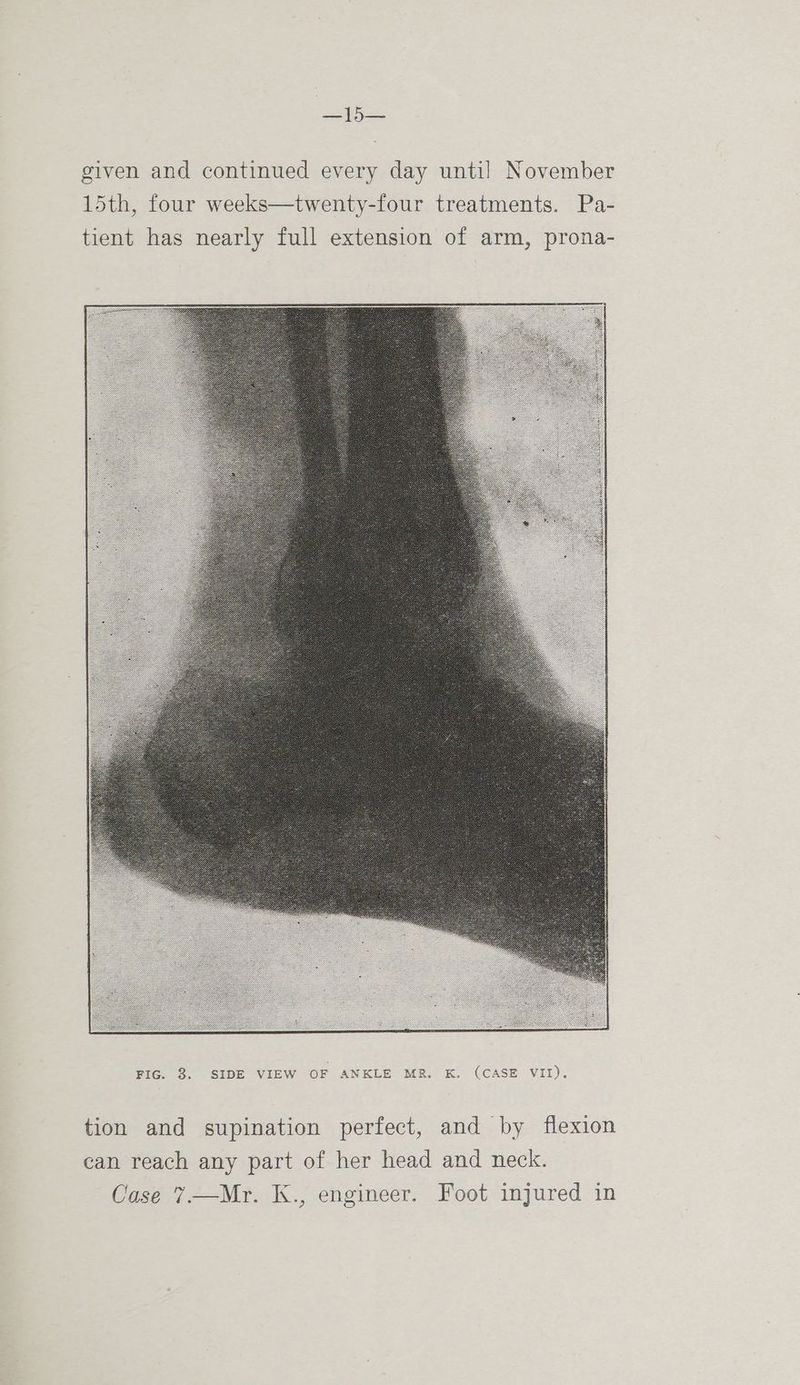 pe given and continued every day until November 15th, four weeks—twenty-four treatments. Pa- tient has nearly full extension of arm, prona- > fe tion and supination perfect, and by flexion can reach any part of her head and neck. Case 7.—Mr. K., engineer. Foot injured in