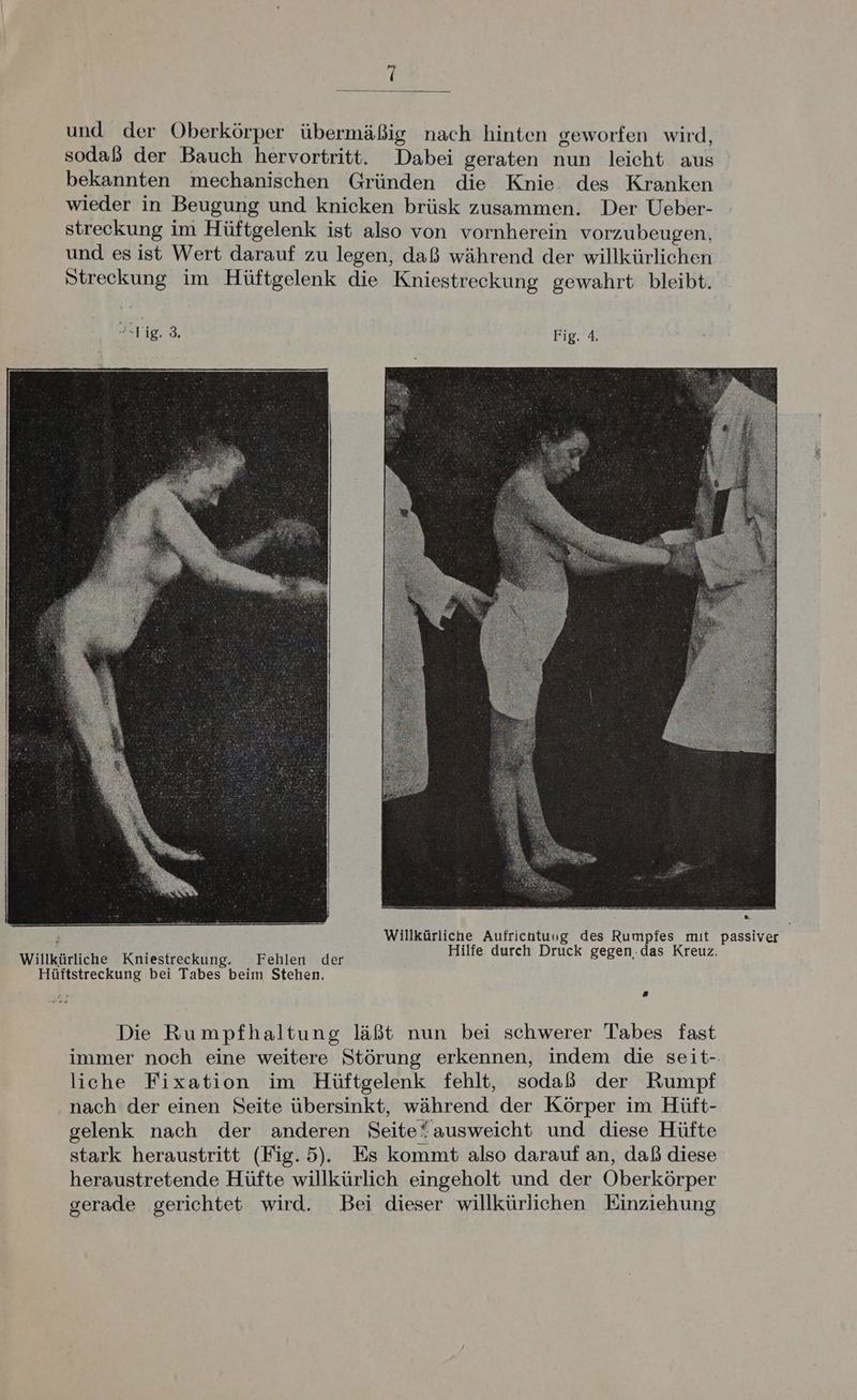 und der Oberkörper übermäßig nach hinten geworfen wird, sodaß der Bauch hervortritt. Dabei geraten nun leicht aus bekannten mechanischen Gründen die Knie des Kranken wieder in Beugung und knicken brüsk zusammen. Der Ueber- streckung im Hüftgelenk ist also von vornherein vorzubeugen, und esist Wert darauf zu legen, daß während der willkürlichen Streckung im Hüftgelenk die Kniestreckung gewahrt bleibt. fig. 3, Fig. 4. = Willkürliche Aufrichtuug des Rumpfes mit passiver | Willkürliche Kniestreckung. Fehlen der DE Aus ce DruEET Bogen, Jazz Kr eu Hüftstreckung bei Tabes beim Stehen. Die Rumpfhaltung läßt nun bei schwerer Tabes fast immer noch eine weitere Störung erkennen, indem die seit- liche Fixation im Hüftgelenk fehlt, sodaß der Rumpf ‚nach der einen Seite übersinkt, während der Körper im Hüft- gelenk nach der anderen Seite“ausweicht und diese Hüfte stark heraustritt (Fig. 5). Es kommt also darauf an, daß diese heraustretende Hüfte willkürlich eingeholt und der Oberkörper gerade gerichtet wird. Bei dieser willkürlichen Einziehung