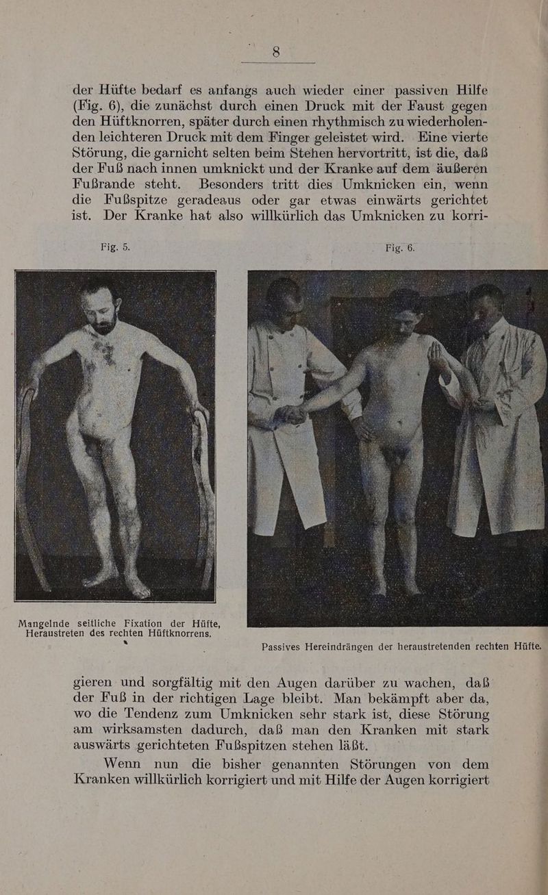 der Hüfte bedarf es anfangs auch wieder einer passiven Hilfe (Fig. 6), die zunächst durch einen Druck mit der Faust gegen den Hüftknorren, später durch einen rhythmisch zu wiederholen- den leichteren Druck mit dem Finger geleistet wird. Eine vierte Störung, die garnicht selten beim Stehen hervortritt, ist die, daß der Fuß nach innen umknickt und der Kranke auf dem äußeren Fußrande steht. Besonders tritt dies Umknicken ein, wenn die Fußspitze geradeaus oder gar etwas einwärts gerichtet ist. Der Kranke hat also willkürlich das Umknicken zu korri- Fig. 5. Fig. 6. Mangelnde seitliche Fixation der Hüfte, Heraustreten des rechten Hüftknorrens. “ Passives Hereindrängen der heraustretenden rechten Hüfte. gieren und sorgfältig mit den Augen darüber zu wachen, daß der Fuß in der richtigen Lage bleibt. Man bekämpft aber da, wo die Tendenz zum Umknicken sehr stark ist, diese Störung am wirksamsten dadurch, daß man den Kranken mit stark auswärts ‚gerichteten Fußspitzen stehen läßt. Wenn nun die bisher genannten Störungen von dem Kranken willkürlich korrigiert und mit Hilfe der Augen korrigiert