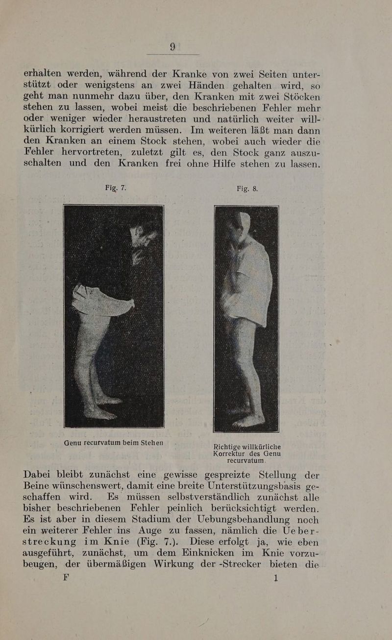 erhalten werden, während der Kranke von zwei Seiten unter- stützt oder wenigstens an zwei Händen. gehalten wird, so geht man nunmehr dazu über, den Kranken mit zwei Stöcken stehen zu lassen, wobei meist die beschriebenen Fehler mehr oder weniger wieder heraustreten und natürlich weiter will- kürlich korrigiert werden müssen. Im weiteren läßt man dann den Kranken an einem Stock stehen, wobei auch wieder die Fehler hervortreten, zuletzt gilt es, den Stock ganz auszu- schalten und den Kranken frei ohne Hilfe stehen zu lassen. Genu recurvatum beim Stehen Richtige willkärliche Korrektur des Genu recurvatum, Dabei bleibt zunächst eine gewisse gespreizte Stellung der Beine wünschenswert, damit eine breite Unterstützungsbasis ge- schaffen wird. Es müssen selbstverständlich zunächst alle bisher beschriebenen Fehler peinlich berücksichtigt werden. Es ist aber in diesem Stadium der Uebungsbehandlung noch ein weiterer Fehler ins Auge zu fassen, nämlich die Ueber- streckung im Knie (Fig. 7.). Diese erfolgt ja, wie eben ausgeführt, zunächst, um dem Einknicken im Knie vorzu- beugen, der übermäßigen Wirkung der -Strecker bieten die F 1