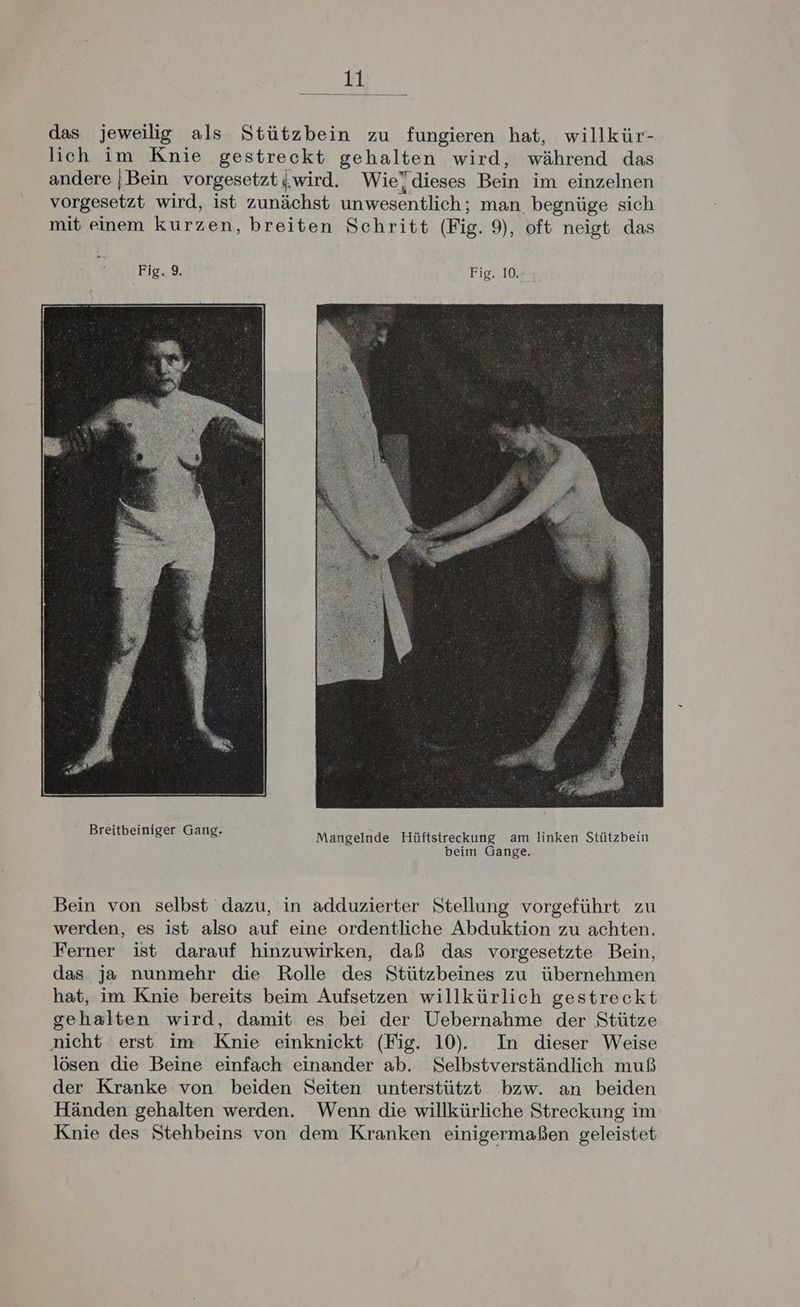 Ey das jeweilig als Stützbein zu fungieren hat, willkür- lich im Knie gestreckt gehalten wird, während das andere |Bein vorgesetztj;wird. Wie)dieses Bein im einzelnen vorgesetzt wird, ist zunächst unwesentlich; man begnüge sich mit einem kurzen, breiten Schritt (Fig. 9), oft neigt das Fig. 9. Fig. 10. Mangelnde Hüftstreckung am linken Stützbein beim Gange. Bein von selbst dazu, in adduzierter Stellung vorgeführt zu werden, es ist also auf eine ordentliche Abduktion zu achten. Ferner ist darauf hinzuwirken, daß das vorgesetzte Bein, das ja nunmehr die Rolle des Stützbeines zu übernehmen hat, im Knie bereits beim Aufsetzen willkürlich gestreckt gehalten wird, damit es bei der Uebernahme der Stütze nicht erst im Knie einknickt (Fig. 10. In dieser Weise lösen die Beine einfach einander ab. Selbstverständlich muß der Kranke von beiden Seiten unterstützt bzw. an beiden Händen gehalten werden. Wenn die willkürliche Streckung im Knie des Stehbeins von dem Kranken einigermaßen geleistet