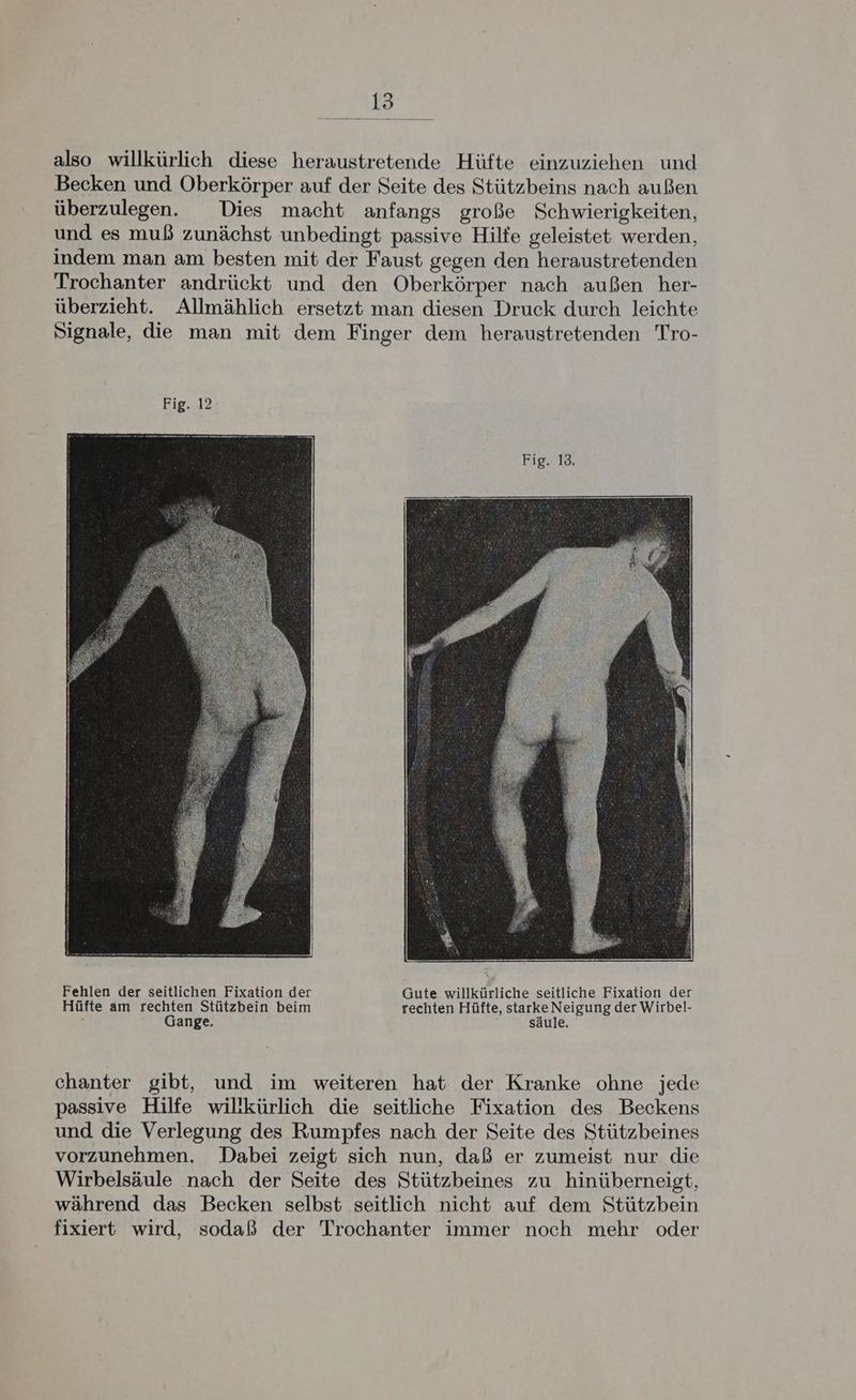 also willkürlich diese heraustretende Hüfte einzuziehen und Becken und Oberkörper auf der Seite des Stützbeins nach außen überzulegen. Dies macht anfangs große Schwierigkeiten, und es muß zunächst unbedingt passive Hilfe geleistet werden, indem man am besten mit der Faust gegen den heraustretenden Trochanter andrückt und den Oberkörper nach außen her- überzieht. Allmählich ersetzt man diesen Druck durch leichte Signale, die man mit dem Finger dem heraustretenden Tro- Fehlen der seitlichen Fixation der Gute willkürliche seitliche Fixation der Hüfte am rechten Stützbein beim rechten Hüfte, starke Neigung der Wirbel- Gange. säule. chanter gibt, und im weiteren hat der Kranke ohne jede passive Hilfe willkürlich die seitliche Fixation des Beckens und die Verlegung des Rumpfes nach der Seite des Stützbeines vorzunehmen. Dabei zeigt sich nun, daß er zumeist nur die Wirbelsäule nach der Seite des Stützbeines zu hinüberneigt, während das Becken selbst seitlich nicht auf dem Stützbein fixiert wird, sodaß der Trochanter immer noch mehr oder