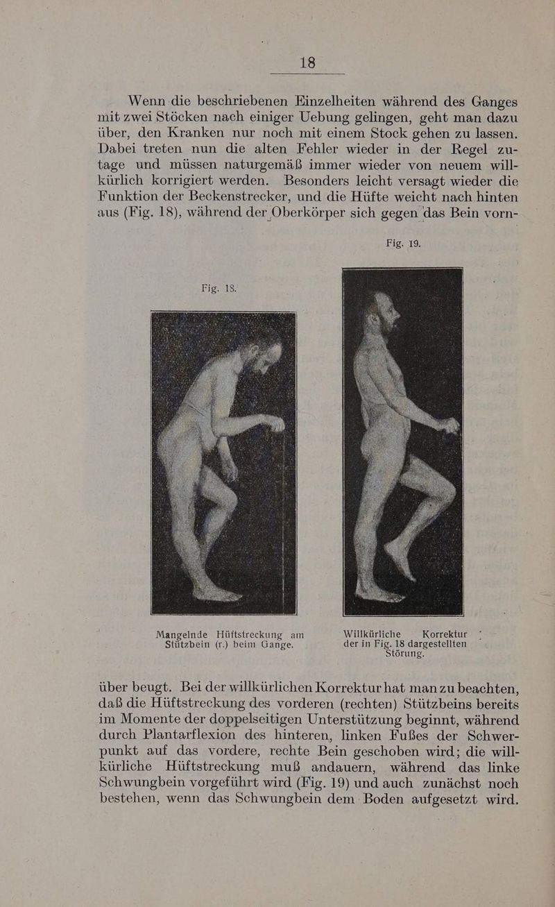 Wenn die beschriebenen Einzelheiten während des Ganges mit zwei Stöcken nach einiger Uebung gelingen, geht man dazu über, den Kranken nur noch mit einem Stock gehen zu lassen. Dabei treten nun die alten Fehler wieder in der Regel zu- tage und müssen naturgemäß immer wieder von neuem will- kürlich korrigiert werden. Besonders leicht versagt wieder die Funktion der Beckenstrecker, und die Hüfte weicht nach hinten aus (Fig. 18), während der Oberkörper sich gegen das Bein vorn- Mangelnde Hüftstreckung am Willkürliche Korrektur Stützbein (r.) beim Gange. der in Ha<b dargestellten örung. über beugt. Bei der willkürlichen Korrektur hat man zu beachten, daß die Hüftstreckung des vorderen (rechten) Stützbeins bereits im Momente der doppelseitigen Unterstützung beginnt, während durch Plantarflexion des hinteren, linken Fußes der Schwer- punkt auf das vordere, rechte Bein geschoben wird; die will- kürliche Hüftstreckung muß andauern, während das linke Schwungbein vorgeführt wird (Fig. 19) und auch zunächst noch bestehen, wenn das Schwungbein dem Boden aufgesetzt wird.