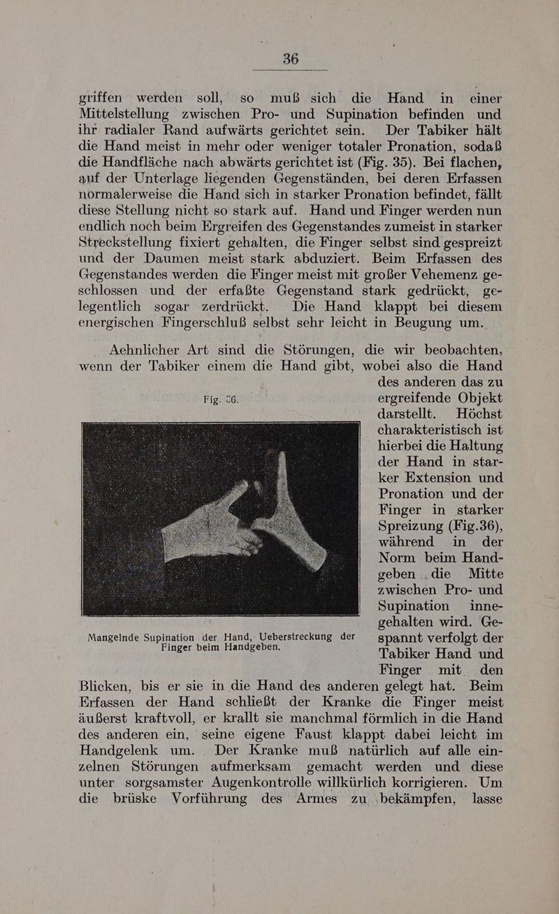 griffen werden soll, so muß sich die Hand in einer Mittelstellung zwischen Pro- und Supination befinden und ihr radialer Rand aufwärts gerichtet sein. Der Tabiker hält die Hand meist in mehr oder weniger totaler Pronation, sodaß die Handfläche nach abwärts gerichtet ist (Fig. 35). Bei flachen, auf der Unterlage liegenden Gegenständen, bei deren Erfassen normalerweise die Hand sich in starker Pronation befindet, fällt diese Stellung nicht so stark auf. Hand und Finger werden nun endlich noch beim Ergreifen des Gegenstandes zumeist in starker Streckstellung fixiert gehalten, die Finger selbst sind gespreizt und der Daumen meist stark abduziert. Beim Erfassen des Gegenstandes werden die Finger meist mit großer Vehemenz ge- schlossen und der erfaßte Gegenstand stark gedrückt, ge- legentlich sogar zerdrückt. Die Hand klappt bei diesem energischen Fingerschluß selbst sehr leicht in Beugung um. Aehnlicher Art sind re Störungen, die wir beobachten, wenn der Tabiker einem die Hand gibt, wobei also die Hand des anderen das zu FIRE ergreifende Objekt darstellt. Höchst charakteristisch ist hierbei die Haltung der Hand in star- ker Extension und Pronation und der Finger in starker Spreizung (Fig.36), während in der Norm beim Hand- geben .die Mitte zwischen Pro- und Supination inne- | gehalten wird. Ge- Mangelnde Supination der. Hand, Ueberstreckung der spannt verfolgt der Finger beim Handgeben. Tebrker Handiend Finger mit den Blicken, bis er sie in die Hand des anderen gelegt hat. Beim Erfassen der Hand schließt der Kranke die Finger meist äußerst kraftvoll, er krallt sie manchmal förmlich in die Hand des anderen ein, seine eigene Faust klappt dabei leicht im Handgelenk um. Der Kranke muß natürlich auf alle ein- zelnen Störungen aufmerksam gemacht werden und diese unter sorgsamster Augenkontrolle willkürlich korrigieren. Um die brüske Vorführung des Armes zu ‚bekämpfen, lasse