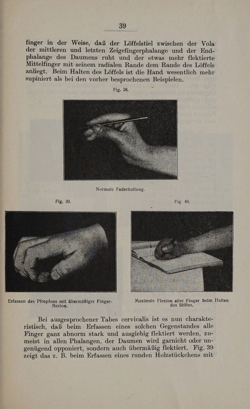 finger in der Weise, daß der Löffelstiel zwischen der Vola der mittleren und letzten Zeigefingerphalange und der End- phalange des Daumens ruht und der etwas mehr flektierte Mittelfinger mit seinem radialen Rande dem Rande des Löffels anliegt. Beim Halten des Löffels ist die Hand wesentlich mehr Supiniert als bei den vorher besprochenen Beispielen. Fig. 39. Fig 40, Bei ausgesprochener Tabes cervicalis ist es nun charakte- ristisch, daß beim Erfassen eines solchen Gegenstandes alle Finger ganz abnorm stark und ausgiebig tlektiert werden, zu- meist in allen Phalangen, der Daumen wird garnicht oder un- genügend opponiert, sondern auch übermäßig flektiert. Fig. 39 zeigt das z. B. beim Erfassen eines runden Holzstückchens mit