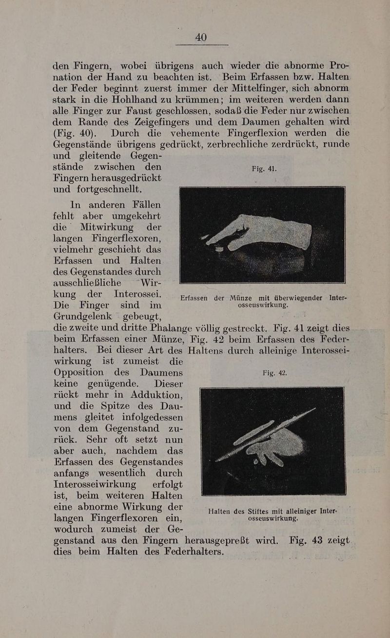 den Fingern, wobei übrigens auch wieder die abnorme Pro- nation der Hand zu beachten ist. Beim Erfassen bzw. Halten der Feder beginnt zuerst immer der Mittelfinger, sich abnorm stark in die Hohlhand zu krümmen; im weiteren werden dann alle Finger zur Faust geschlossen, sodaß die Feder nur zwischen dem Rande des Zeigefingers und dem Daumen gehalten wird (Fig. 40). Durch die vehemente Fingerflexion werden die Gegenstände übrigens gedrückt, zerbrechliche zerdrückt, runde und gleitende Gegen- stände zwischen den Fig. 41. Fingern herausgedrückt und fortgeschnellt. In anderen Fällen fehlt aber umgekehrt die Mitwirkung der langen Fingerflexoren, vielmehr geschieht das Erfassen und Halten des Gegenstandes durch ausschließlicke Wir- kung der Interossei. Erfassen der Münze mit überwiegender Inter- Die Finger sind im osseuswirkung. Grundgelenk gebeugt, die zweite und dritte Phalange völlig gestreckt. 126 41 Sa dies beim Erfassen einer Münze, Fig. 42 beim Erfassen des Feder- halters. Bei dieser Art des Haltens durch alleinige Interossei- wirkung ist zumeist die Opposition des Daumens Fig. 42. keine genügende Dieser rückt mehr in Adduktion, und die Spitze des Dau- mens gleitet infolgedessen von dem Gegenstand zu- rück. Sehr oft setzt nun aber auch, nachdem das Erfassen des Gegenstandes anfangs wesentlich durch Interosseiwirkung erfolgt ist, beim weiteren Halten eine abnorme Wirkung der