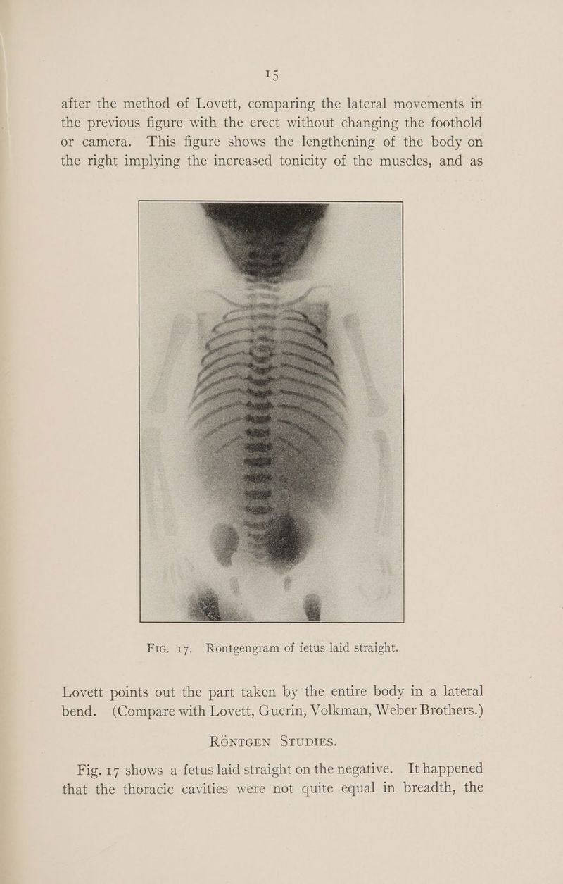 after the method of Lovett, comparing the lateral movements in the previous figure with the erect without changing the foothold or camera. This figure shows the lengthening of the body on the right implying the increased tonicity of the muscles, and as Lovett points out the part taken by the entire body in a lateral bend. (Compare with Lovett, Guerin, Volkman, Weber Brothers.) RONTGEN STUDIES. Fig. 17 shows a fetus laid straight on the negative. It happened that the thoracic cavities were not quite equal in breadth, the