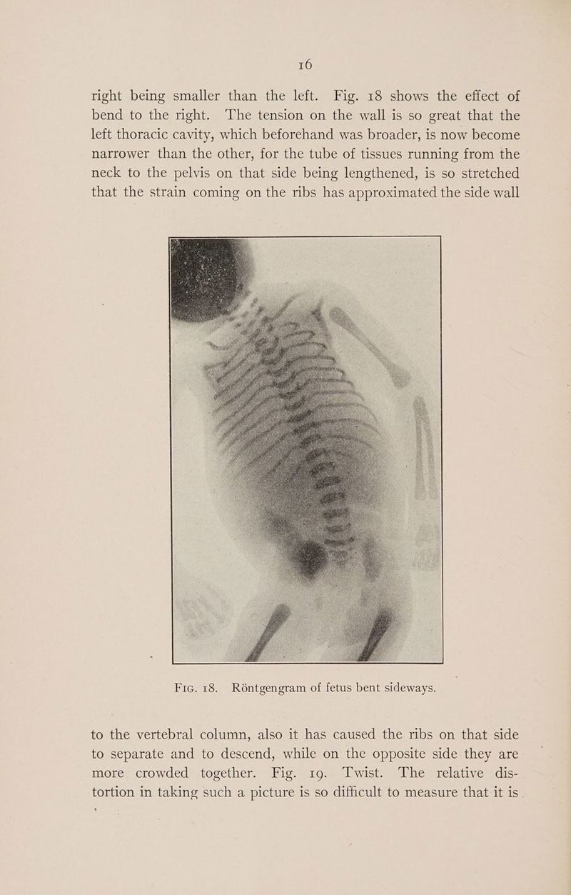 right being smaller than the left. Fig. 18 shows the effect of bend to the right. The tension on the wall is so great that the left thoracic cavity, which beforehand was broader, is now become narrower than the other, for the tube of tissues running from the neck to the pelvis on that side being lengthened, is so stretched that the strain coming on the ribs has approximated the side wall to the vertebral column, also it has caused the ribs on that side to separate and to descend, while on the opposite side they are more. crowded together. Fig. 19. Twist. The relative dis- tortion in taking such a picture is so difficult to measure that it is ¥
