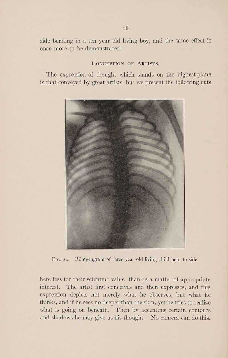 side bending in a ten year old living boy, and the same effect is once more to be demonstrated. CONCEPTION OF ARTISTS. The expression of thought which stands on the highest plane is that conveyed by great artists, but we present the following cuts Fic. 20. R6ntgengram of three year old living child bent to side. here less for their scientific value than as a matter of appropriate interest. The artist first conceives and then expresses, and this expression depicts not merely what he observes, but what he thinks, and if he sees no deeper than the skin, yet he tries to realize what is going on beneath. Then by accenting certain contours and shadows he may give us his thought. No camera can do this.