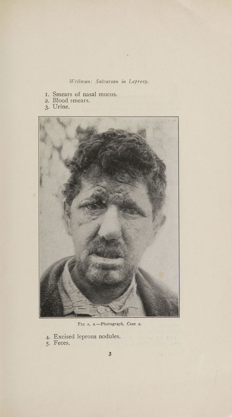 I. Smears of nasal mucus. 2. Blood smears. 3.. Urine. : 4. Excised leprous nodules. 5. Feces. i