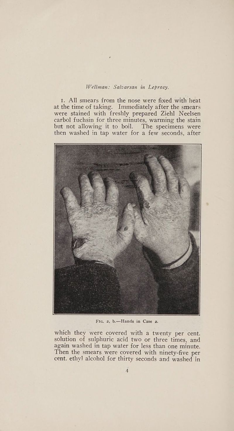 1. All smears from the nose were fixed with heat at the time of taking. Immediately after the smears were stained with freshly prepared Ziehl Neelsen carbol fuchsin for three minutes, warming the stain but not allowing it to boil. The specimens were then washed in tap water for a few seconds, after which they were covered with a twenty per cent. solution of sulphuric acid two or three times, and again washed in tap water for less than one minute. Then the smears were covered with ninety-five per cent. ethv! alcohol for thirty seconds and washed in