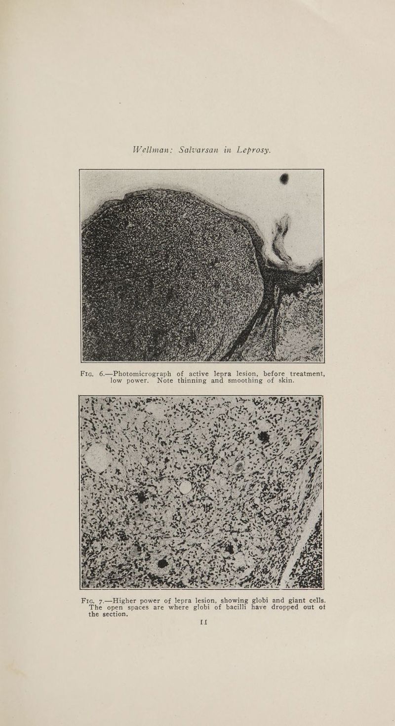 Fic. 6.—Photomicrograph of active lepra lesion, before treatment, low power. Note thinning and smoothing of skin. Fic. 7.—Higher power of lepra lesion, showing globi and giant cells. The open spaces are where globi of bacilli have dropped out ot the section. {f