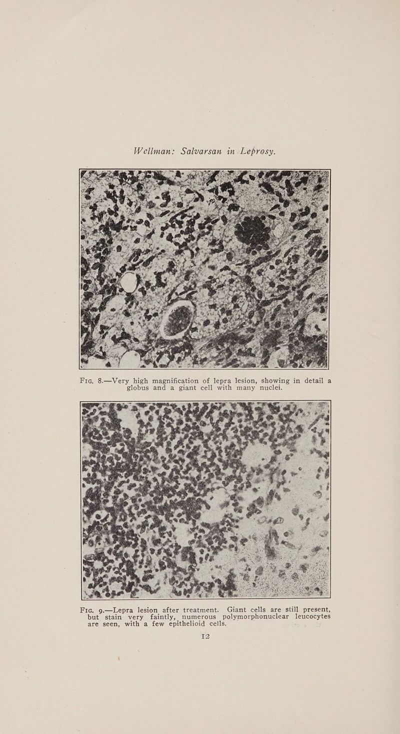 Fic, 8.—Very high magnification of lepra lesion, showing in detail a globus and a giant cell with many nuclei. {2