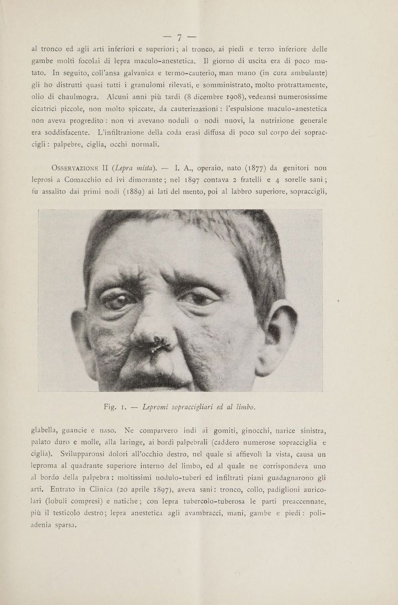 ==> vi NI al tronco ed agli arti inferiori e superiori; al tronco, ai piedi e terzo inferiore delle gambe molti focolai di lepra maculo-anestetica. Il giorno di uscita era di poco mu- tato. In seguito, coll’ansa galvanica e termo-cauterio, man mano (in cura ambulante) gli ho distrutti quasi tutti i granulomi rilevati, e somministrato, molto protrattamente, olio di chaulmogra. Alcuni anni più tardi (8 dicembre 1908), vedeansi numerosissime cicatrici piccole, non molto spiccate, da cauterizzazioni : l'espulsione maculo-anestetica non aveva progredito : non vi avevano noduli o nodi nuovi, la nutrizione generale era soddisfacente. L'’infiltrazione della coda erasi diffusa di poco sul corpo dei soprac- cigli: palpebre, ciglia, occhi normali. OsseRryAZIONE II (Lepra mista). — I. A., operaio, nato (1877) da genitori non leprosi a Comacchio ed ivi dimorante; nel 1897 contava 2 fratelli e 4 sorelle sani; fu assalito dai primi nodi (1889) ai lati del mento, poi al labbro superiore, sopraccigli, glabella, guancie e naso. Ne comparvero indi ai gomiti, ginocchi, narice sinistra, palato duro e molle, alla laringe, ai bordi palpebrali (caddero numerose sopracciglia e ciglia). Svilupparonsi dolori all’occhio destro, nel quale si affievoli la vista, causa un leproma al quadrante superiore interno del limbo, ed al quale ne corrispondeva uno al bordo della palpebra: moltissimi nodulo-tuberi ed infiltrati piani guadagnarono gli arti. Entrato in Clinica (20 aprile 1897), aveva sani: tronco, collo, padiglioni aurico- lari (lobuli compresi) e natiche; con lepra tubercolo-tuberosa le parti preaccennate, più il testicolo destro; lepra anestetica agli avambracci, mani, gambe e piedi: poli- adenia sparsa.