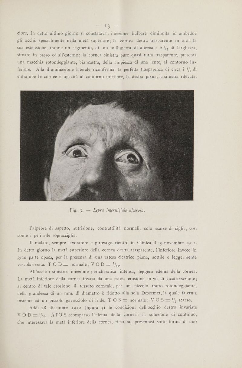 ciore. In detto ultimo giorno si constatava: iniezione bulbare diminuita in ambedue gli occhi, specialmente nella metà superiore; la cornea destra trasparente in tutta la sua estensione, tranne un segmento, di un millimetro di altezza e 2/, di larghezza, situato in basso ed all’esterno; la cornea sinistra pure quasi tutta trasparente, presenta una macchia rotondeggiante, biancastra, della ampiezza di una lente, al contorno in- feriore. Alla illuminazione laterale riconfermai la perfetta trasparenza di circa i 4/, di entrambe le cornee e opacità al contorno inferiore, la destra piana, la sinistra rilevata. Palpebre di aspetto, nutrizione, contrattilità normali, solo scarse di ciglia, così come i peli alle sopracciglia. Il malato, sempre lavoratore e girovago, rientrò in Clinica il 19 novembre 1912. In detto giorno la metà superiore della cornea destra trasparente, l’inferiore invece in gran parte opaca, per la presenza di una estesa cicatrice piana, sottile e leggermente vaseolarizzata, 1-0 Di== normale; VO D'—= */,0 All’occhio sinistro: iniezione pericheratica intensa, leggero edema della cornea. La metà inferiore della cornea invasa da una estesa erosione, in via di cicatrizzazione; al centro di tale erosione il tessuto corneale, per un piccolo tratto rotondeggiante, della grandezza di un mm. di diametro è ridotto alla sola Descemet, la quale fa ernia insieme ad un piccolo gavocciolo di iride, TOS = normale; VO S = !/5 scarso. Addì 28 dicembre 1912 (figura 3) le condizioni dell’occhio destro invariate VOD=8/;. AIl’OS scomparso l’edema della cornea: la soluzione di continuo, che interessava la metà inferiore della cornea, riparata, presentasi sotto forma di uno