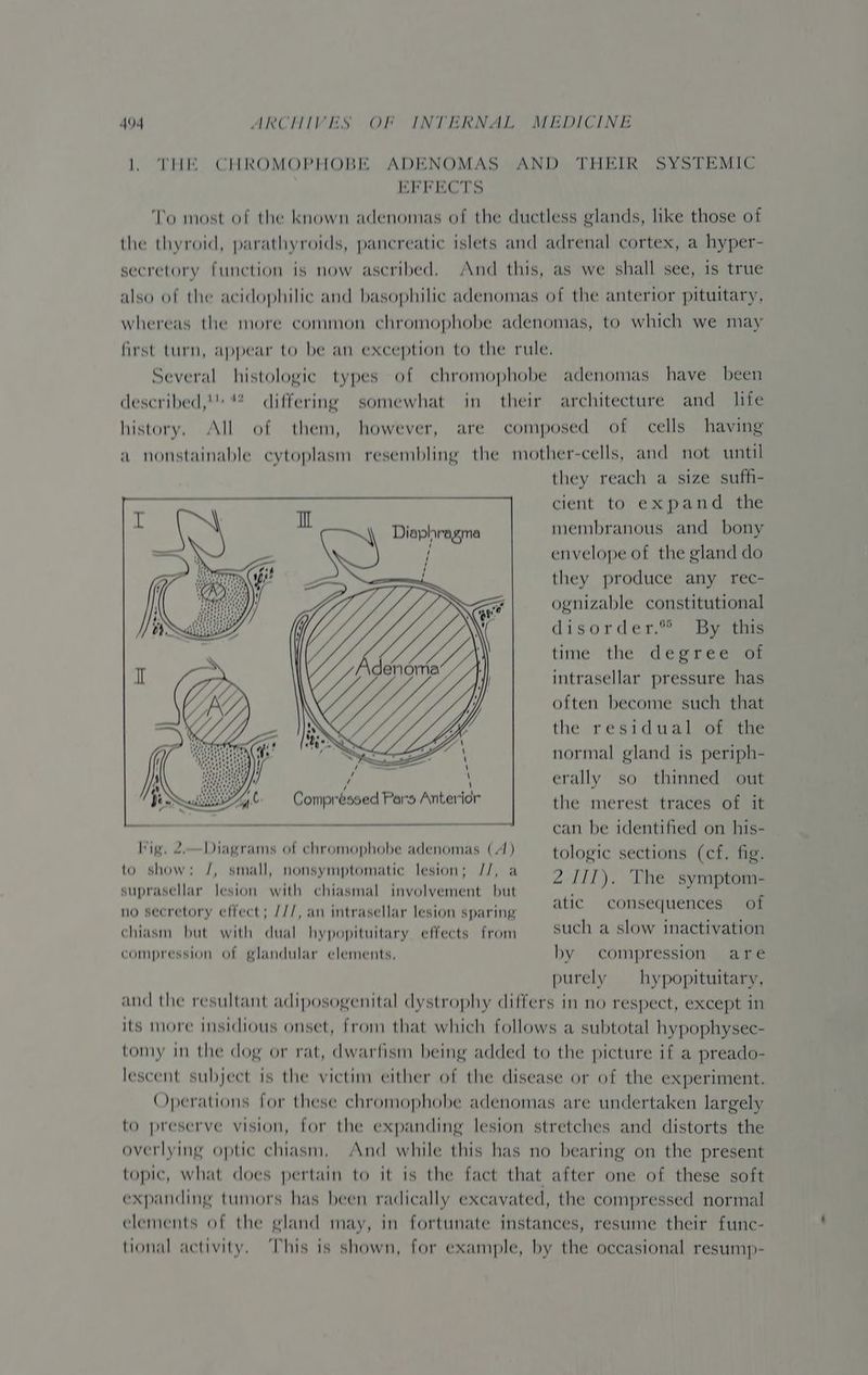 1 THE CHROMOPHOBE ADENOMAS AND THEIR SYSTEMIC EFFECTS To most of the known adenomas of the ductless glands, like those of the thyroid, parathyroids, pancreatic islets and adrenal cortex, a hyper- secretory funetion is now ascribed. And this, as we shall see, is true also of the acidophilic and basophilic adenomas of the anterior pituitary, whereas the more common chromophobe adenomas, to which we may first turn, appear to be an exception to the rule. Several histologic types of chromophobe adenomas have been described,! differing somewhat in their architecture and_ life history. All of them, however, are composed of cells having a nonstainable cytoplasm resembling the mother-cells, and not until they reach a size suffi- cient to expand the Diaphragma membranous and bony envelope of the gland do they produce any rec- ognizable constitutional disorder.” By this time the cdépréeca. intrasellar pressure has often become such that the residual of the normal gland is periph- erally so thinned out the merest traces of it can be identified on his- Mig, 2.—Diagrams of chromophobe adenomas (A) tologic sections (cf. fig. to show: J, small, nonsymptomatic lesion; //, a 2 IIT) The symptom- suprasellar lesion with chiasmal involvement but E i / / f ‘ no secretory effect; ///, an intrasellar lesion sparing tes ee ot chiasm but with dual hypopituitary effects from such a slow inactivation compression of glandular elements. by compression are purely hypopituitary, and the resultant adiposogenital dystrophy differs in no respect, except in its more insidious onset, from that which follows a subtotal hypophysec- tomy in the dog or rat, dwarfism being added to the picture if a preado- lescent subject is the victim either of the disease or of the experiment. Operations for these chromophobe adenomas are undertaken largely to preserve vision, for the expanding lesion stretches and distorts the overlying optic chiasm, And while this has no bearing on the present topic, what does pertain to it is the fact that after one of these soft expanding tumors has been radically excavated, the compressed normal elements of the gland may, in fortunate instances, resume their func- tional activity. This is shown, for example, by the occasional resump-