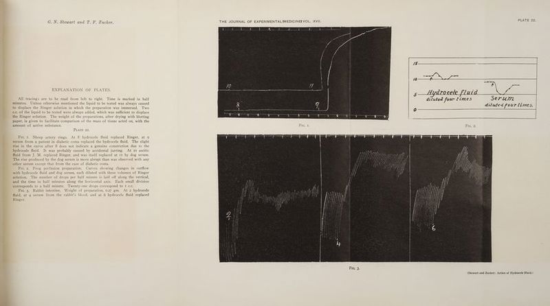 EXPLANATION OF PLATES. All tracings are to be read from left to right. Time is marked in half minutes. Unless otherwise mentioned the liquid to be tested was always caused to displace the Ringer solution in which the preparation was immersed. Two c.c. of the liquid to be tested were always added, which was sufficient to displace the Ringer solution. The weight of the preparations, after drying with blotting paper, is given to facilitate comparison of the mass of tissue acted on, with the amount of active substance. PLATE 22. Fic. 1. Sheep artery rings. At 8 hydrocele fluid replaced Ringer, at 9 serum from a patient in diabetic coma replaced the hydrocele fluid. The slight rise in the curve after 8 does not indicate a genuine constriction due to the hydrocele fluid. It was probably caused by accidental jarring. At 10 ascitic fluid from J. M. replaced Ringer, and was itself replaced at 11 by dog serum. The rise produced by the dog serum is more abrupt than was observed with any other serum except that from the case of diabetic coma. Fic. 2. Frog perfusion preparation. Curves showing changes in outflow with hydrocele fluid and dog serum, each diluted with three volumes of Ringer solution. The number of drops per half minute is laid off along the vertical, and the time in half minutes along the horizontal axis. Each small division corresponds to a half minute. Twenty-one drops correspond to I c.c. Fic. 3. Rabbit intestine. Weight of preparation, 0.27 gm. At 2 hydrocele fluid, at 4 serum from the rabbit’s blood, and at 6 hydrocele fluid replaced Ringer. Sb PLATE 22. diluted four times Seru7. diluted four limes.