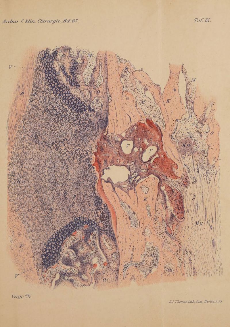 Archiv f klin. Chirurgie, Bd 67. Vergr °% LJ Thomas Lith Inst, Berlin.S 53.