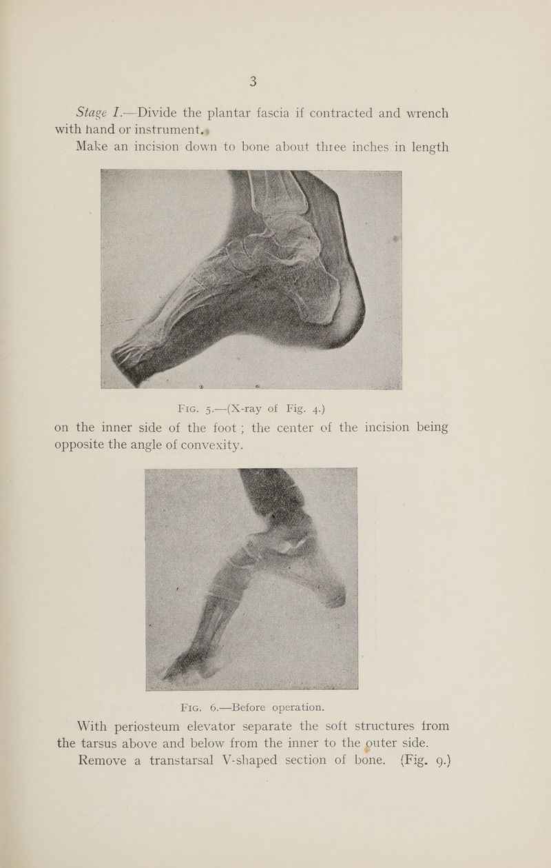Stage I.—Divide the plantar fascia if contracted and wrench with hand or instrument.» Make an incision down to bone about three inches in length Fic. 5.—(X-ray of Fig. 4.) on the inner side of the foot; the center of the incision being opposite the angle of convexity. With periosteum elevator separate the soft structures from the tarsus above and below from the inner to the outer side. Remove a transtarsal V-shaped section of bone. (Fig. 9.)