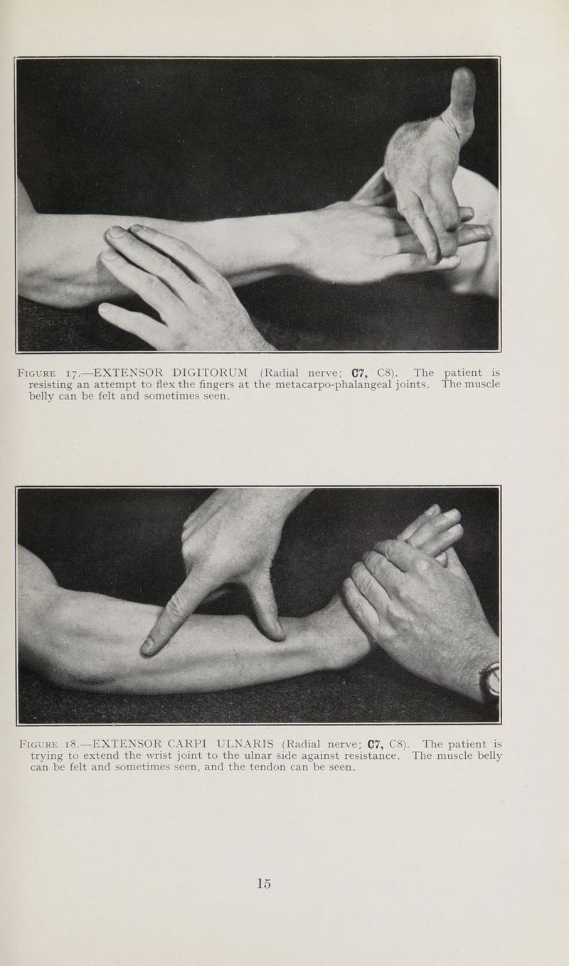 FIGURE 17.—EXTENSOR DIGITORUM (Radial nerve; C7, C8). The patient is resisting an attempt to flex the fingers at the metacarpo-phalangeal joints. The muscle belly can be felt and sometimes seen.