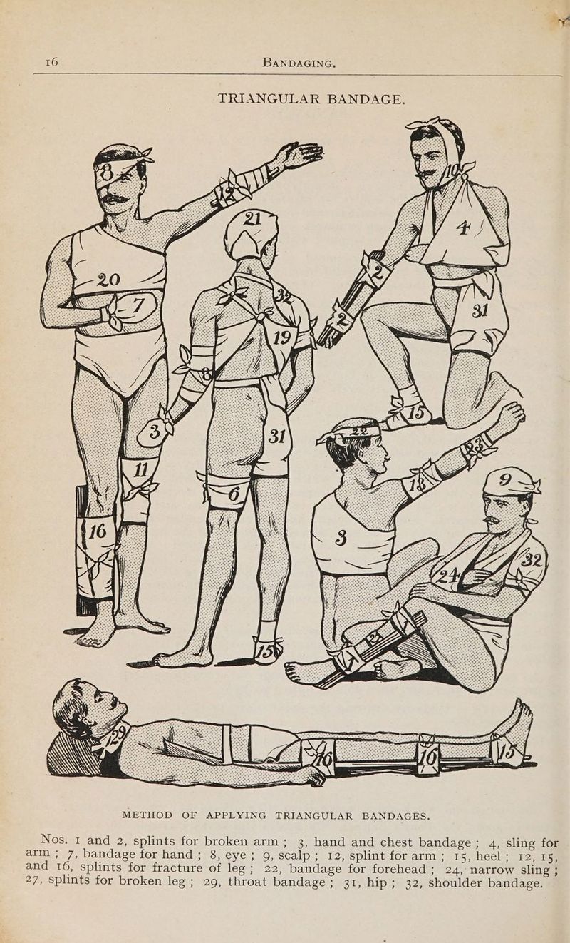 TRIANGULAR BANDAGE. AWS: METHOD OF APPLYING TRIANGULAR BANDAGES. Nos. 1 and 2, splints for broken arm; 3, hand and chest bandage ; 4, sling for arm ; 7, bandage for hand; 8, eye; 9, scalp; 12, splint for arm; 15, heel ; 12,.153 and 16, splints for fracture of leg; 22, bandage for forehead; 24, narrow sling ; 27, splints for broken leg; 29, throat bandage; 31, hip; 32, shoulder bandage.