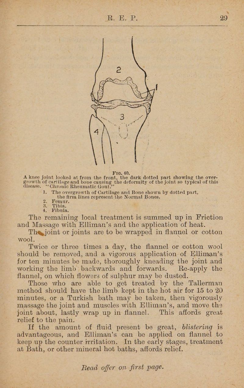 Fic. 40. A knee joint looked at from the front, the dark dotted part showing the over- growth of cartilage and bone causing the deformity of the joint so typical of this disease. ‘‘Chrouic Rheumatic Gout.’ 1. The overgrowth of Cartilage and Bone shown by dotted part, the firm lines represent the Normal Bones. 2. Femur, 3. Tibia. 4. Fibula. The remaining local treatment is summed up in Friction and Massage with Elliman’s and the application of heat. The, joint or joints are to be wrapped in flannel or cotton wool, Aah Twice or three times a day, the flannel or cotton wool should be removed, and a vigorous application of Hlliman’s for ten minutes be made, thoroughly kneading the joint and working the hmb backwards and forwards. Re-apply the flannel, on which flowers of sulphur may be dusted. Those who are able to get treated by the Tallerman method should have the limb kept in the hot air for 15 to 20 minutes, or a Turkish bath may be taken, then vigorously massage the joint and muscles with Elliman’s, and move the joint about, lastly wrap up in flannel. This affords great relief to the pain. If the amount of fluid present be great, blistering is advantageous, and Elliman’s can be applied on flannel to keep up the counter rrritation. In the early stages, treatment at Bath, or other mineral hot baths, affords relief.