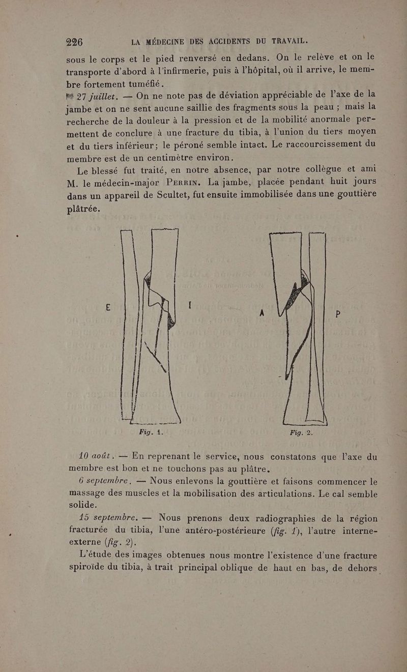 sous le corps et le pied renversé en dedans. On le relève et on le transporte d’abord à l'infirmerie, puis à l'hôpital, où il arrive, le mem- bre fortement tuméfié. Bé 27 juillet. — On ne note pas de déviation appréciable de l’axe de la jambe et on ne sent aucune saillie des fragments sous la peau ; mais la recherche de la douleur à la pression et de la mobilité anormale per- mettent de conclure à une fracture du tibia, à l’union du tiers moyen et du tiers inférieur; le péroné semble intact. Le raccourcissement du membre est de un centimètre environ. Le blessé fut traité, en notre absence, par notre collègue et ami M. le médecin-major PERRIN. La jambe, placée pendant huit jours dans un appareil de Scultet, fut ensuite immobilisée dans une gouttière plâtrée. E [ P Fig. 1. Fig. 2. 10 août. — En reprenant le service, nous constatons que l’axe du membre est bon et ne touchons pas au plâtre. 6 septembre. — Nous enlevons la gouttière et faisons commencer le massage des muscles et la mobilisation des articulations. Le cal semble solide. 15 septembre. — Nous prenons deux radiographies de la région fracturée du tibia, l’une antéro-postérieure (fig. 1), l’autre interne- externe (fig. 2). L'étude des images obtenues nous montre l'existence d’une fracture spiroïde du tibia, à trait principal oblique de haut en bas, de dehors
