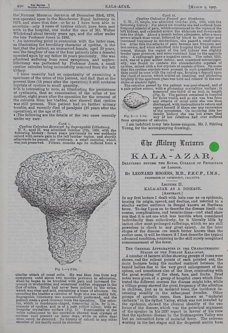 Term BaitisH MapricaL JovsNaL * Ra the’ Brrrish Mepican JourNAL of December 23rd, 1876, was operated upon in the Manchester Royal Infirmary in 1874, and since that date—as faras I have been able to ascertain—only 2 cases of cystine caleuli have been met with in the hospital, one under the care of Mr. Walter Whitehead about twenty years ago, and the other under the late Professor Jones in 1892. » An interesting point in connexion with the latter case, ‘as illustrating the hereditary character of cystine, is the fact that the patient, an unmarried female, aged 20 years, was the daughter of one of the four patients (also a female) operated upon by my father 24 years previously. She was ‘admitted suffering from renal symptoms, and nephro- lithotomy was performed by Professor Jones, a small cystine calculus being successfully removed from the left kidney. I have recently had an opportunity of examining a specimen of the urine of this patient, and find that at the ‘present time (14 years after the operation) it still contains crystals of cystine in small quantity. titIt is interesting to note, as illustrating the persistence -of cystinuria, that an examination of the urine of her mother, eight years after the operation for the removal of the caleulus from her bladder, also showed that cystine was still present. This patient had no further urinary ‘trouble, and recently died of paralysis (34 years after the -operation), at the age of 67. 4 |The following are the details of the two cases recently under my care: CASE I. Cystine Calculus Removed by Suprapubic Lithotomy. W. S., aged 32, was admitted October 17th, 1906, with the following history: Seven years previously he was suddenly ‘seized with severe pain in the left lumbar region, and shortly afterwards he passed, per urethram, a small calculus, which xvas not preserved. Fifteen months ago he suffered from a \ Line r : sedi AVNG Gira “ys FD siege} DP Aer ped ] tebe ea fi Pea! similar attack of renal colic. He was then free from any ‘symptoms until about two months previous to admission, when he began to be troubled with pain and increased fre- quency in micturition, and occasional sudden stoppage in the dow of urine. Blood had never been noticed in the urine, which was clear and acid, containing atrace ofalbumen. On ‘sounding the bladder a calculus of large size was readily felt. Suprapubic lithotomy was successfully performed, and the patient made a good recovery from the operation. The calcu- lus, which is mushroom-shaped, measuring lin. by lyin., consists of cystine, and is of a pale yellow colour, with an irregular crystalline surface (Fig. 1). Examination of the urine subsequent to the operation showed that crystals of ‘cystine were present on some days, while on other days none could be detected. No history of calculi in any other member of his family could be obtained. |Marcn 2, 1907. CASE Il. Cystine Calculus Passed per Urethram. C. W., 22, single, was admitted October 19th, 1906, with the following history : For about six months she had suffered from frequent attacks of pain, which commenced in the region of the left kidney, and extended across the abdomen and downwards into the thigh. About a month before admission, after a more severe attack than usual, followed by blood in the urine and increased frequency in micturition, she passed a small calcu- lus. After this the attacks of pain became less frequent and less severe, and when admitted into hospital they had almost ceased, though the region of the left kidney was slightly tender upon pressure, and more resistant than on the opposite side. A radiograph gave a negative result. The urine, 1020, acid, was of a pale amber colour, and, examined microscopic- ally, was found to contain the characteristic crystals of cystine, mixed with a few crystals of oxalate oflime. Onsome days the cystine crystals were present in such quantities that they could be seen with the naked eye, forming a deposit upon the cloud of mucus, which settled on standing, and glistening brightly if the specimen glass was held and rotated in the sun- shine or electric light. The calculus passed by the patient was pear-shaped, and of a pale yellow colour, with a glistening crystalline surface; if measured one-third of an inch in length (Fig. 2). The patient remained in hospital for three weeks, and as she was free from any attacks of renal colic she was then discharged, with instructions to return and report herself if there was any recurrence of the symptoms. On inquiring into her family history she was not aware that any of her relatives had ever suffered Che Milroy Wertures &amp; KADLA-AZAR, DELIVERED BEFORE THE RoyaL COLLEGE OF PHYSICIANS or LONDON. By LEONARD ROGERS, M.D., F.R.C.P., I.M.S., PROFESSOR OF PATHOLOGY, CALCUTTA. Lecture II. KALA-AZAR AS A DISEASE, [ABSTRACT. ] In my first lecture I dealt with kala-azar as an epidemic, tracing its origin, spread, and decline, and referred to a similar earlier outbreak in Bengal known as Burdwan fever. To-day I pass on to describe the disease itseli—its course, complications, and terminations—and shall show you that it is not one whit less terrible when considered individually than collectively, for it literally kills by inches after most prolonged sufferings, which we are still powerless to check to any great extent. As the later stages of the disease are much better known than the earlier ones, it will be clearer if I first describe the typical advanced condition, returning to the still rarely recognized commencement of the fever. THE GENERAL APPEARANCES IN THE CHARACTERISTIC STAGES oF THE DISEASE KALA-AZAR, A number of lantern slides showing groups of cases were shown, and the salient points of each pointed out, the main features being the marked contrast between the tumid bellies due to the very great enlargement of the spleen, and sometimes also of the liver, contrasting with the great wasting of the chest, face, and limbs. Brief notes were given of a group of hospital cases which illus- trated the different courses the disease might take, while a village group showed the great frequency of the affection in children, just as in malarial fever, the incidence de- creasing steadily in the subsequent decades. Other groups of sporadic cases, then known as ‘“ malarial cachexia” in the Sylhet Valley, which was not invaded by the epidemic, showed the clinical identity of the two forms of the disease, which was the principal argument of the speaker in his 1897 report in favour of his view that the epidemic disease in the Brahmaputra Valley was but an intensified form of malarial fever. The extreme wasting in the last stages and the dropsical ascitic form