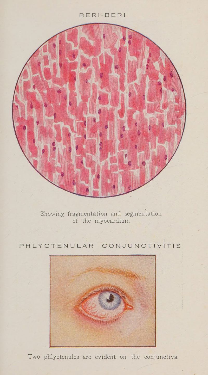 Showing fragmentation and segmentation of the myocardium pa PHLYCTENULAR CONJUNCTIVITIS