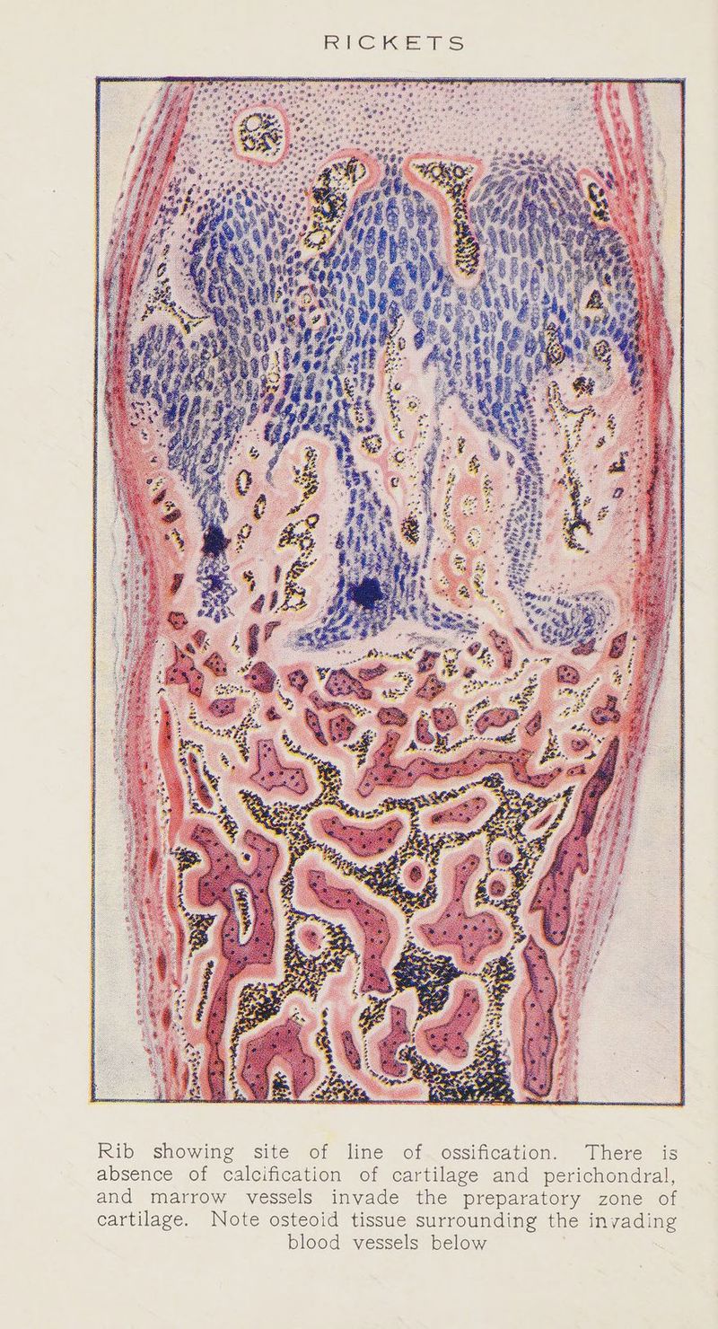 Rib showing site of line of ossification. There is absence of calcification of cartilage and perichondral, and marrow vessels invade the preparatory zone of cartilage. Note osteoid tissue surrounding the invading blood vessels below