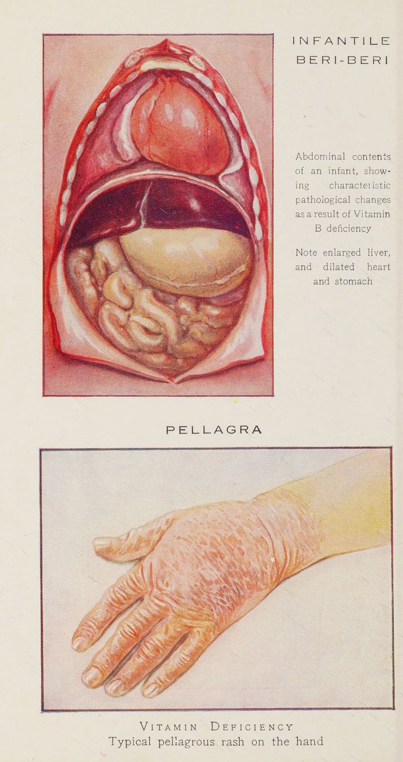 INFANTILE BE RI-BE RI Abdominal contents of an infant, show- ing characteristic pathological changes asa result of Vitamin B deficiency Note enlarged liver, and dilated heart and stomach