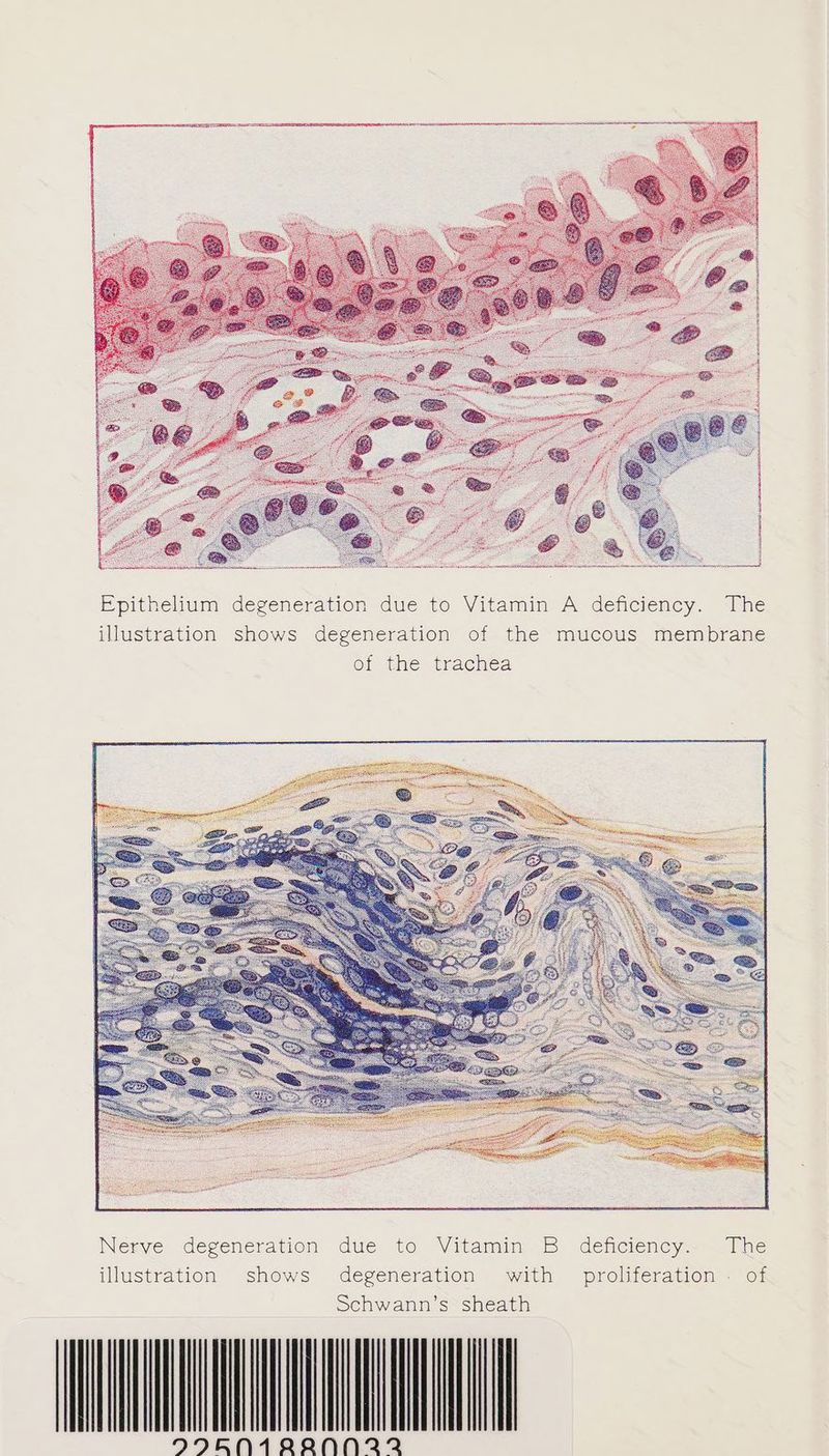 ise osetia ila intiasoereniteiirer eH RIPEN ab Epithelium degeneration due to Vitamin A deficiency. The illustration shows degeneration of the mucous membrane of the trachea AYIBNAR22NN 22