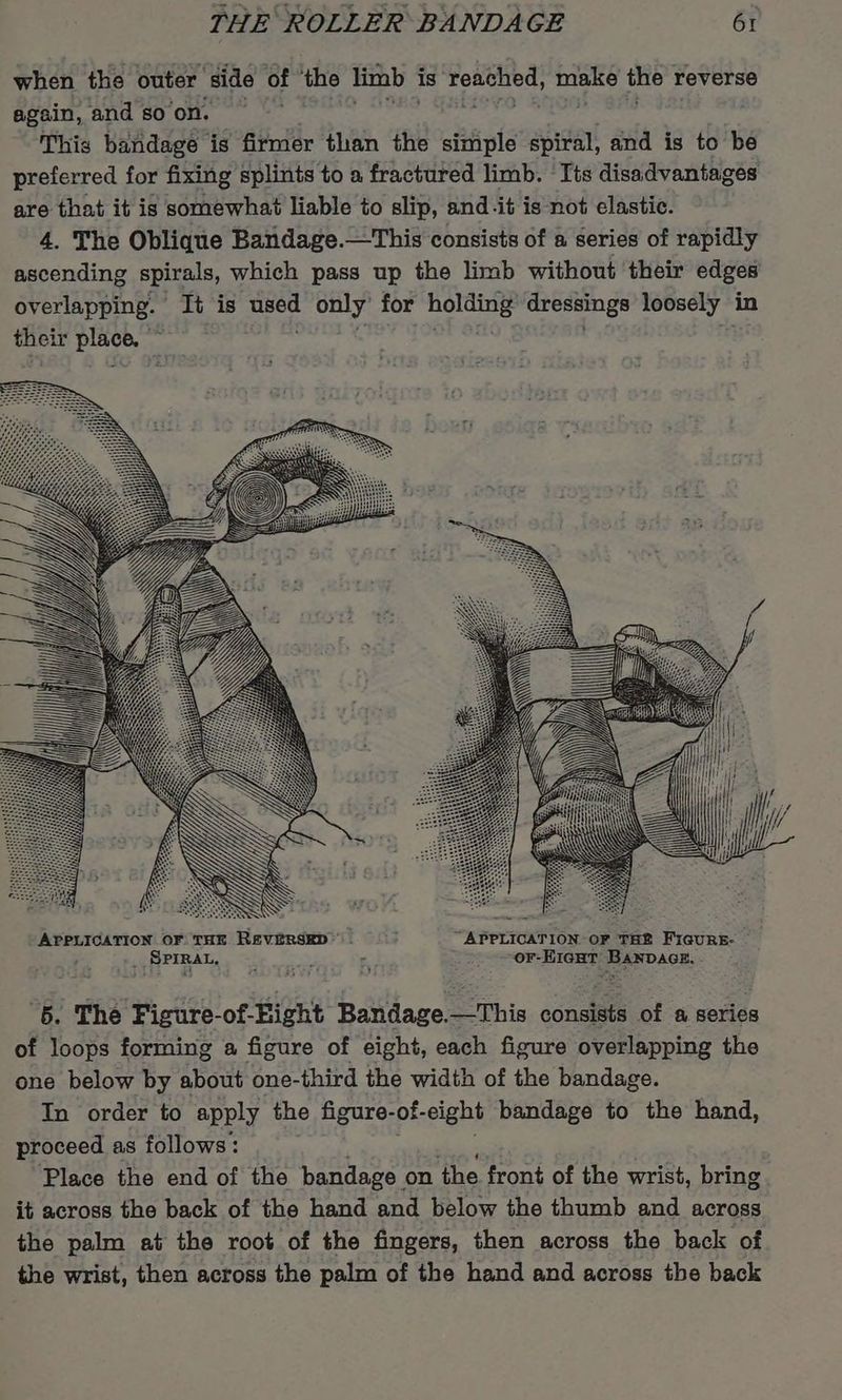 when the outer ‘side of ‘the limb + is AER BOS the reverse again, and so on. This bandage is firmer than the simple spiral, and is to be preferred for fixing splints to a fractured limb. ‘Its disadvantages are that it is somewhat liable to slip, and-it is not elastic. 4. The Oblique Bandage.—This consists of a series of rapidly ascending spirals, which pass up the limb without their edges overlapping. It is ed only’ for aoe dressings loosely in thei ir Ryser * 6. The Figure-of- Right Bandage. This cdnaiaes of a series of loops forming a figure of eight, each figure overlapping the one below by about one-third the width of the bandage. In order to apply the figure- of- eight bandage to the hand, proceed as follows: Place the end of the bandage on the front of the wrist, bring it across the back of the hand and below the thumb and across the palm at the root of the fingers, then across the back of the wrist, then across the palm of the hand and across the back