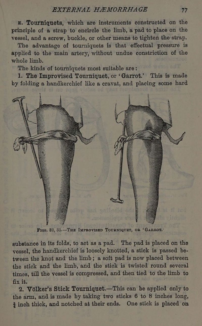 gE. Tourniquets, which are instruments constructed on the principle of a strap to encircle the limb, a pad to place on the vessel, and a screw, buckle, or other means to tighten the strap. The advantage of tourniquets is that effectual pressure is applied to the main artery, without undue constriction of the whole limb. The kinds of tourniquets most suitable are: 1. The Improvised Tourniquet, or ‘Garrot.’ This is made by folding a handkerchief like a cravat, and placing some hard N N N N Fics. 32, 33.—TH Improviskp ToURNIQUET, OR ‘GARROT.° substance in its folds, to act as a pad. The pad is placed on the vessel, the handkerchief is loosely knotted, a stick is passed be- tween the knot and the limb; a soft pad is now placed between the stick and the limb, and the stick is twisted round several times, till the vessel is compressed, and then tied to the limb to fix it. 2. Volker’s Stick Tourniquet.—This can be applied only to the arm, and is made by taking two sticks 6 to 8 inches long, ¢ inch thick, and notched at their ends. One stick is placed on