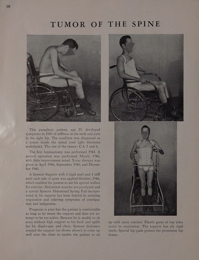 The first laminectomy was performed 1943. A second operation was performed March, 1946, with little improvement noted. X-ray therapy was given in April 1946, September 1946, and Decem- ber 1946, A Spencer Support with 1 rigid steel and 1 stiff steel each side of spine was applied October, 1946, which enabled the patient to use his special walker for exercise. Abdominal muscles are paralyzed and a special Spencer Abdominal Spring Pad incorpo- rated in his support has been helpful in assisting respiration and relieving symptoms of constipa- tion and indigestion. Prognosis is poor but the patient is comfortable as long as he wears the support and does not at- tempt to be too active. Because he is unable to sit erect without high support to his back and uplift for his diaphragm and chest, Spencer designers created the support (as shown above) to come up well over the chest to enable the patient to sit