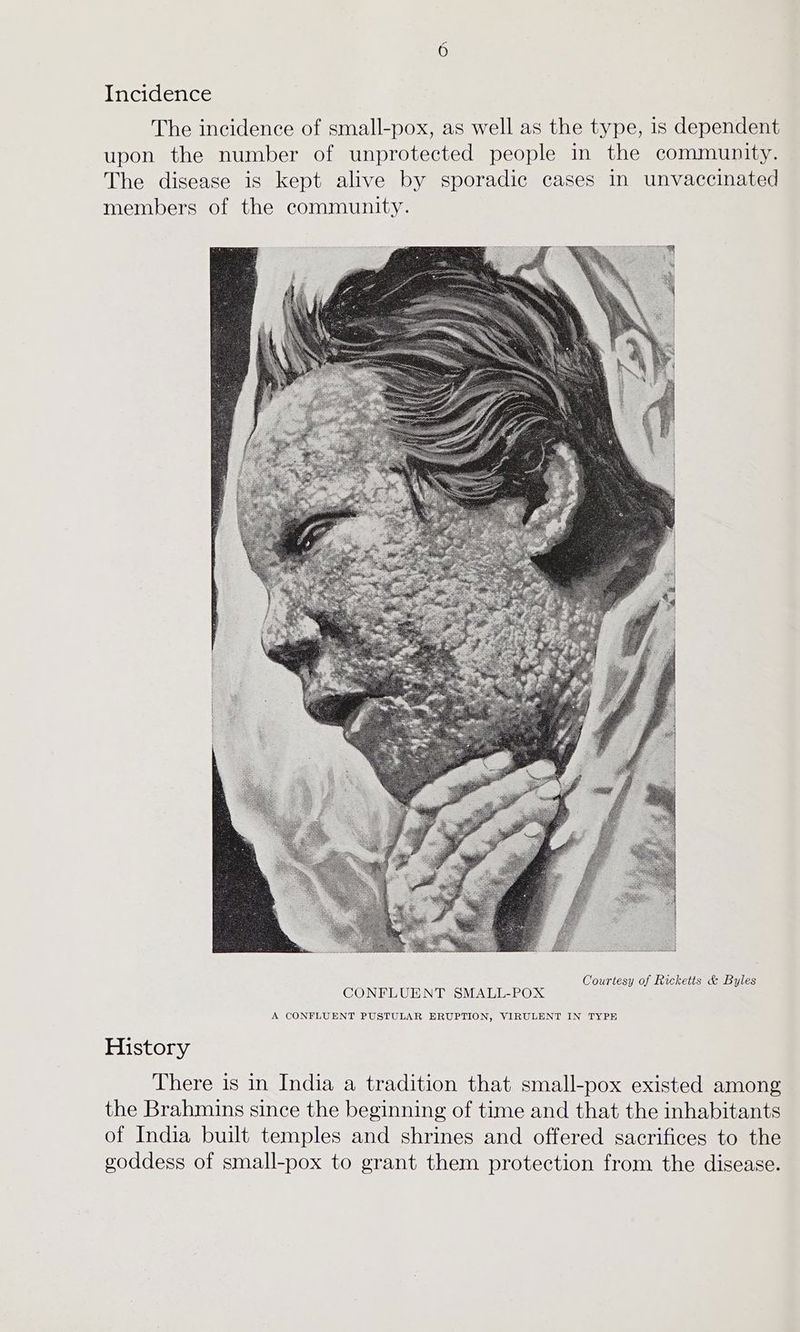 Incidence The incidence of small-pox, as well as the type, 1s dependent upon the number of unprotected people in the community. The disease is kept alive by sporadic cases in unvaccinated members of the community. Courtesy of Ricketts &amp; Byles History There is in India a tradition that small-pox existed among the Brahmins since the beginning of time and that the inhabitants of India built temples and shrines and offered sacrifices to the goddess of small-pox to grant them protection from the disease.