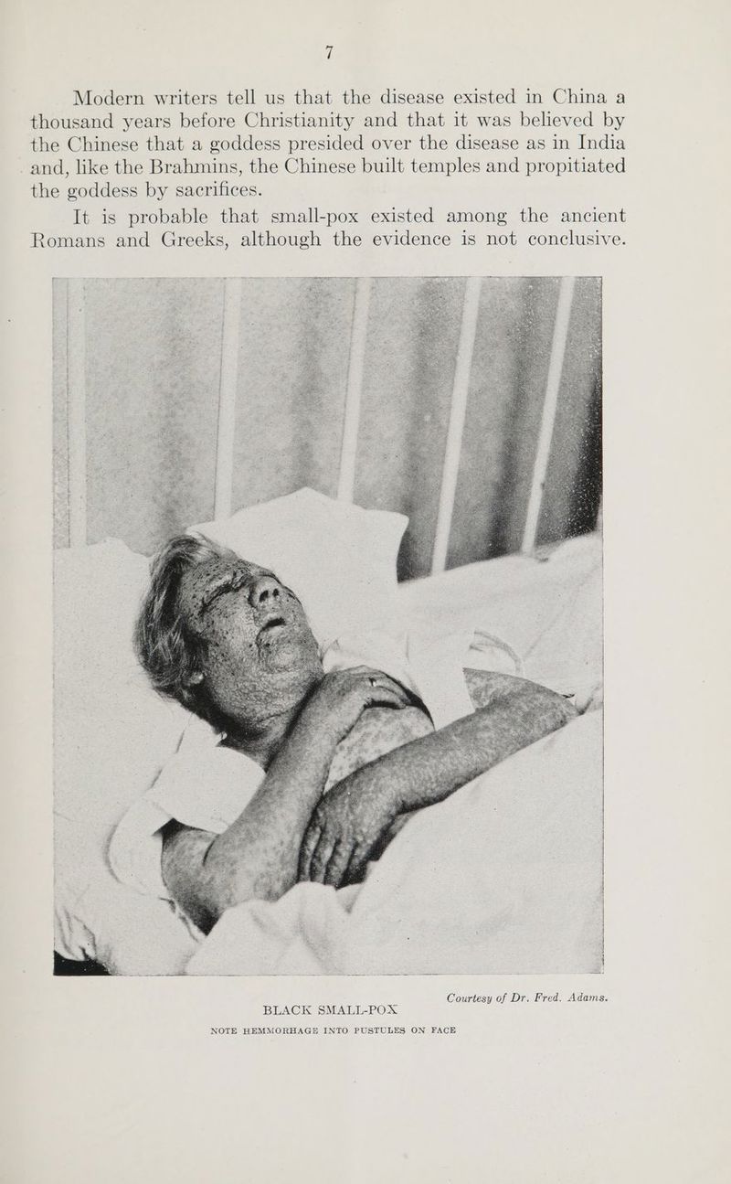 Modern writers tell us that the disease existed in China a thousand years before Christianity and that it was believed by the Chinese that a goddess presided over the disease as in India and, like the Brahmins, the Chinese built temples and propitiated the goddess by sacrifices. It is probable that small-pox existed among the ancient Romans and Greeks, although the evidence is not conclusive. Bane tp Siipes ipeie te costes aera BLACK SMALL-POX NOTE HEMMORHAGE INTO PUSTULES ON FACE