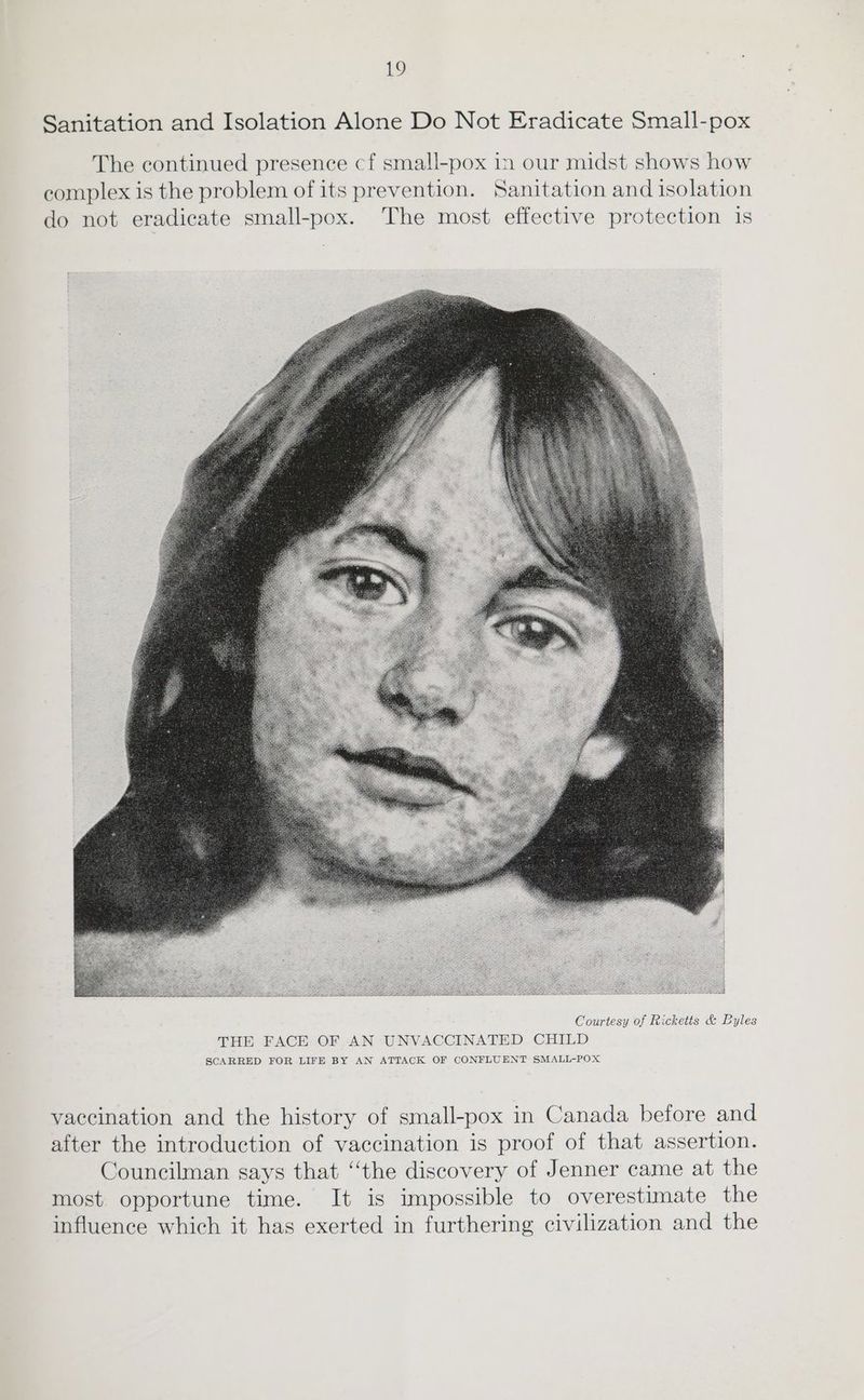 Sanitation and Isolation Alone Do Not Eradicate Small-pox The continued presence cf small-pox in our midst shows how complex is the problem of its prevention. Sanitation and isolation do not eradicate small-pox. The most effective protection is Courtesy of Ricketts &amp; Byles THE FACE OF AN UNVACCINATED CHILD SCARRED FOR LIFE BY AN ATTACK OF CONFLUENT SMALL-POX vaccination and the history of small-pox in Canada before and after the introduction of vaccination is proof of that assertion. Councilman says that “the discovery of Jenner came at the most opportune time. It is impossible to overestimate the influence which it has exerted in furthering civilization and the