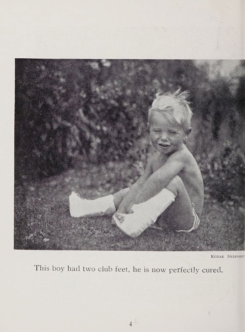 This boy had two club feet, he is now rertectly cured;