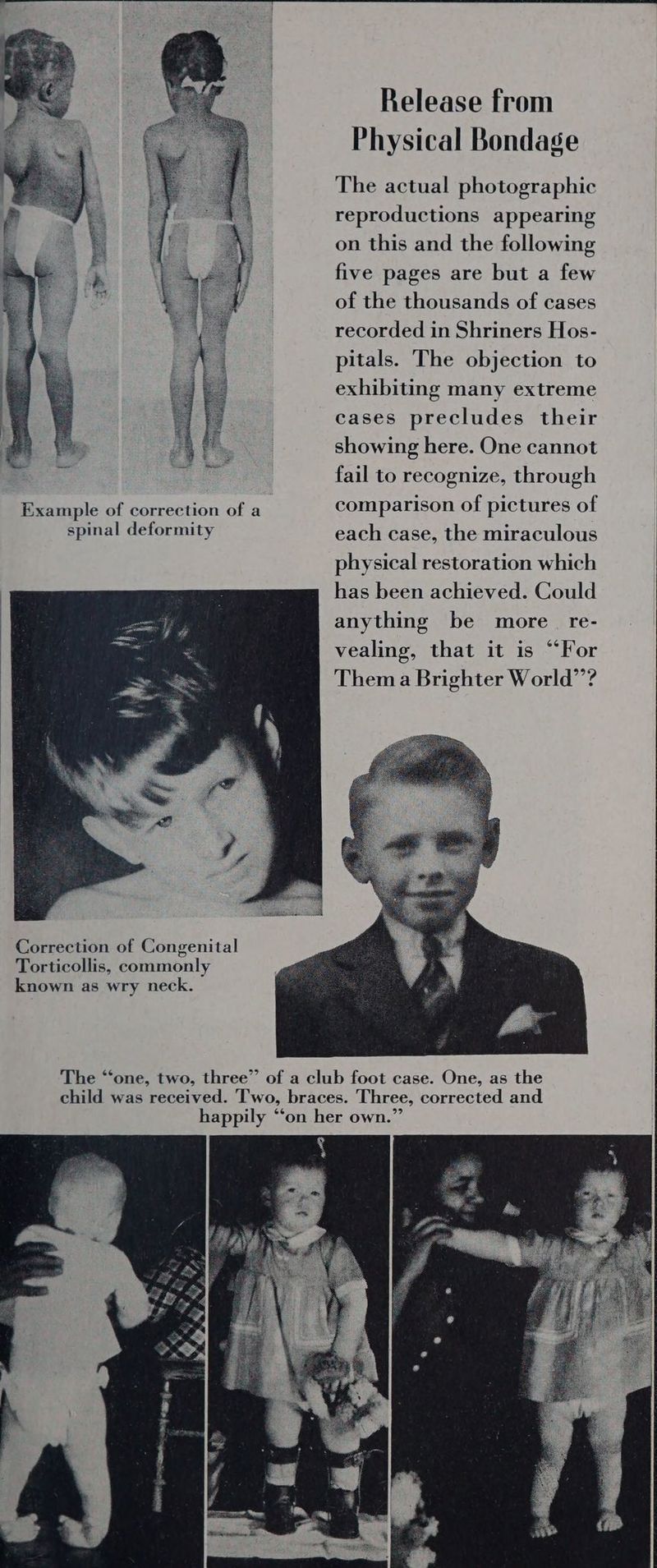Correction of Congenital Torticollis, commonly known as wry neck. Release from Physical Bondage The actual photographic reproductions appearing on this and the following five pages are but a few of the thousands of cases recorded in Shriners Hos- pitals. The objection to exhibiting many extreme cases precludes their showing here. One cannot fail to recognize, through comparison of pictures of each case, the miraculous physical restoration which has been achieved. Could anything be more re- vealing, that it is “For Thema Brighter World”’?