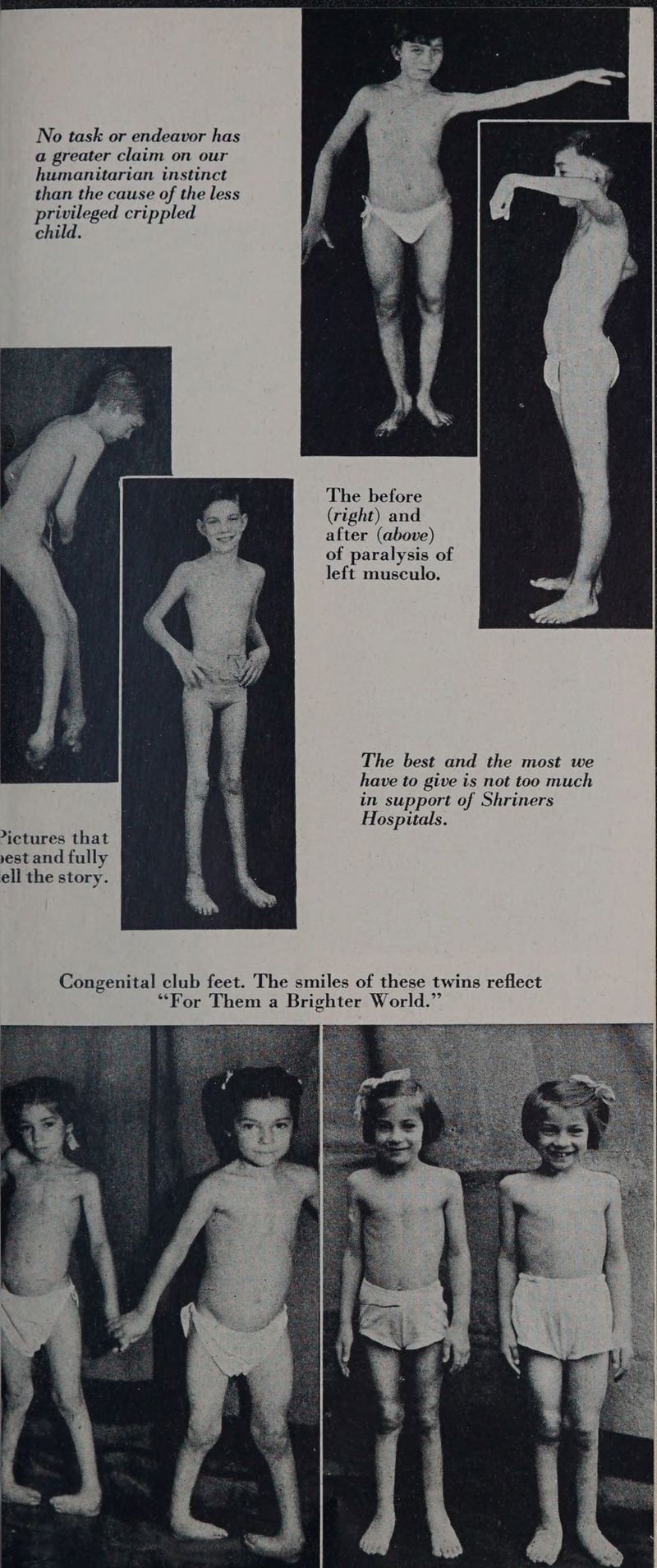 No task or endeavor has a greater claim on our humanitarian instinct than the cause of the less privileged crippled child. The before (right) and after (above) of paralysis of left musculo. The best and the most we have to give is not too much in support of Shriners Hospitals. ictures that vest and fully ell the story.